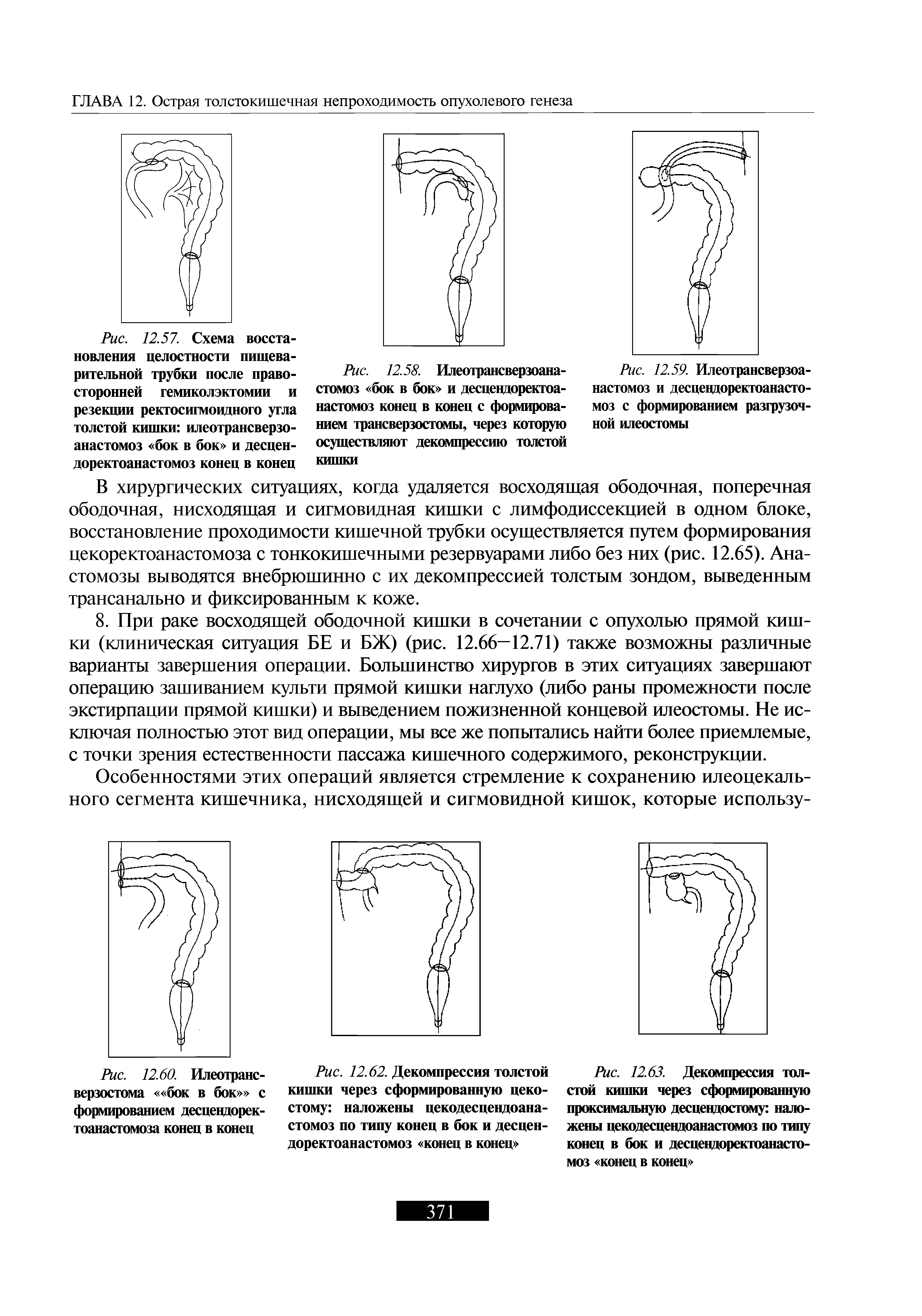 Рис. 12.58. Илеотрансверзоана-стомоз бок в бок и десцендорекгоа-настомоз конец в конец с формированием трансверзостомы, через которую осуществляют декомпрессию толстой кишки...