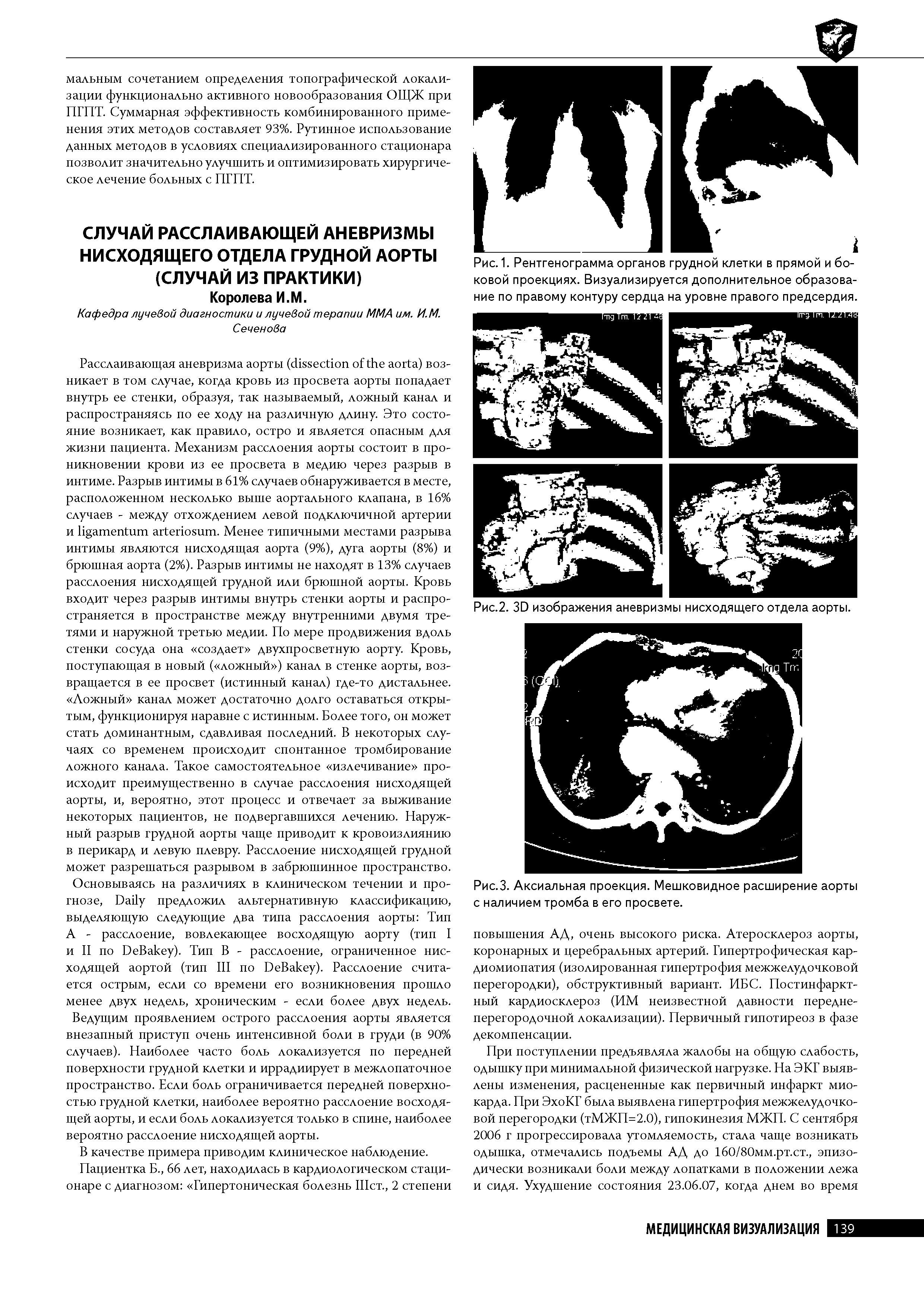 Рис.З. Аксиальная проекция. Мешковидное расширение аорты с наличием тромба в его просвете.