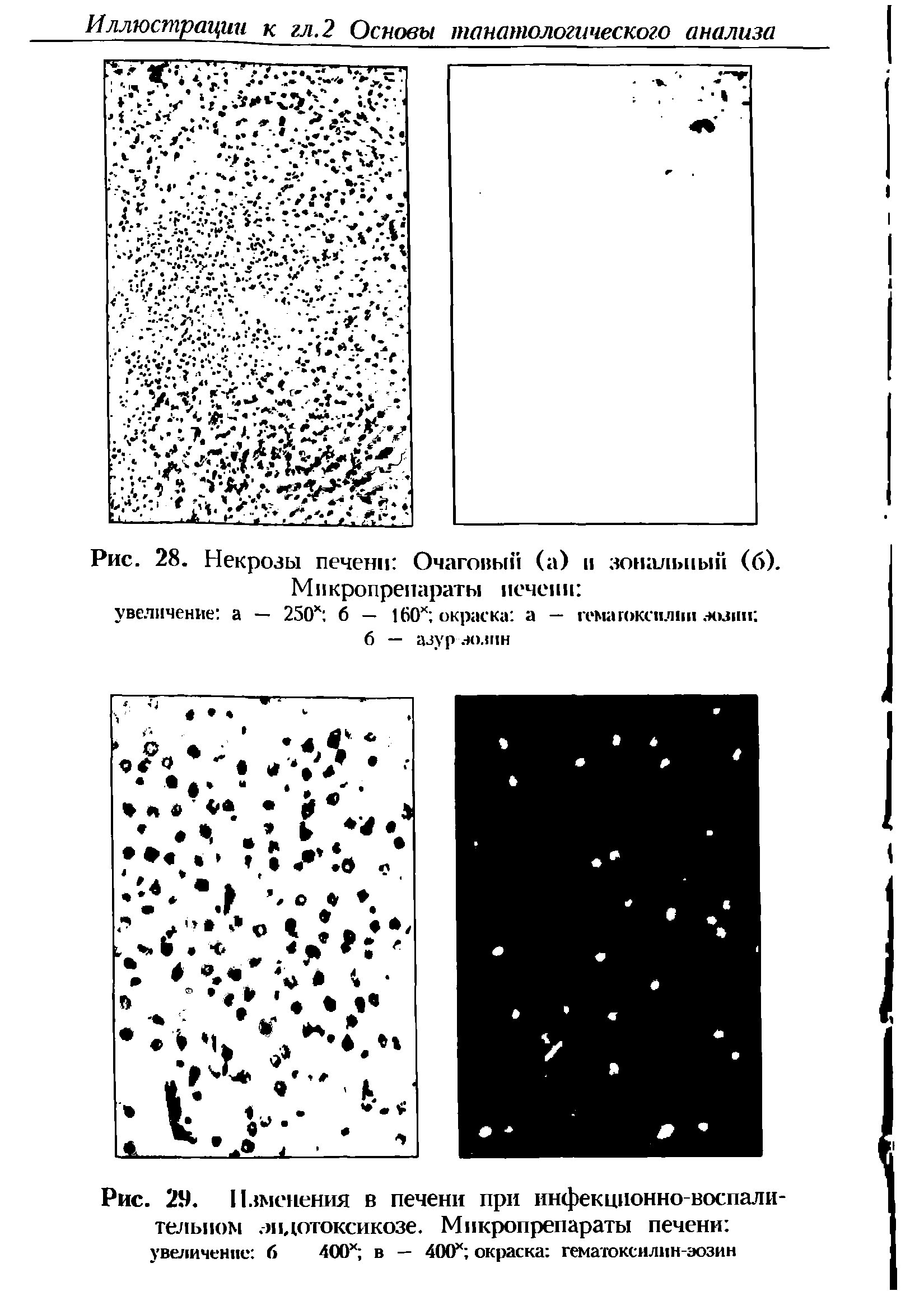 Рис. 28. Некрозы печени Очаговый (а) и зональный (б). Мпкропрепараты печени ...