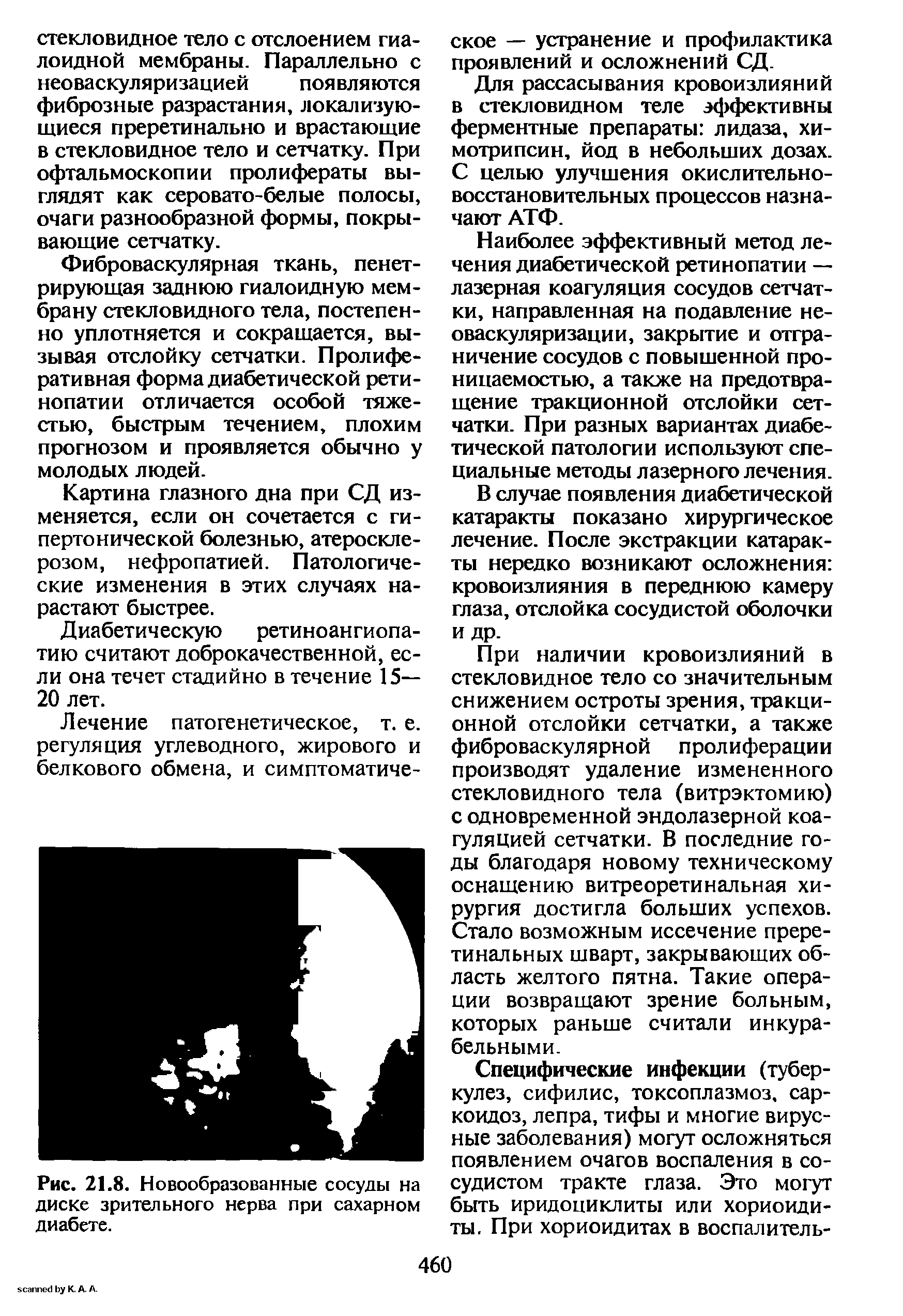 Рис. 21.8. Новообразованные сосуды на диске зрительного нерва при сахарном диабете.