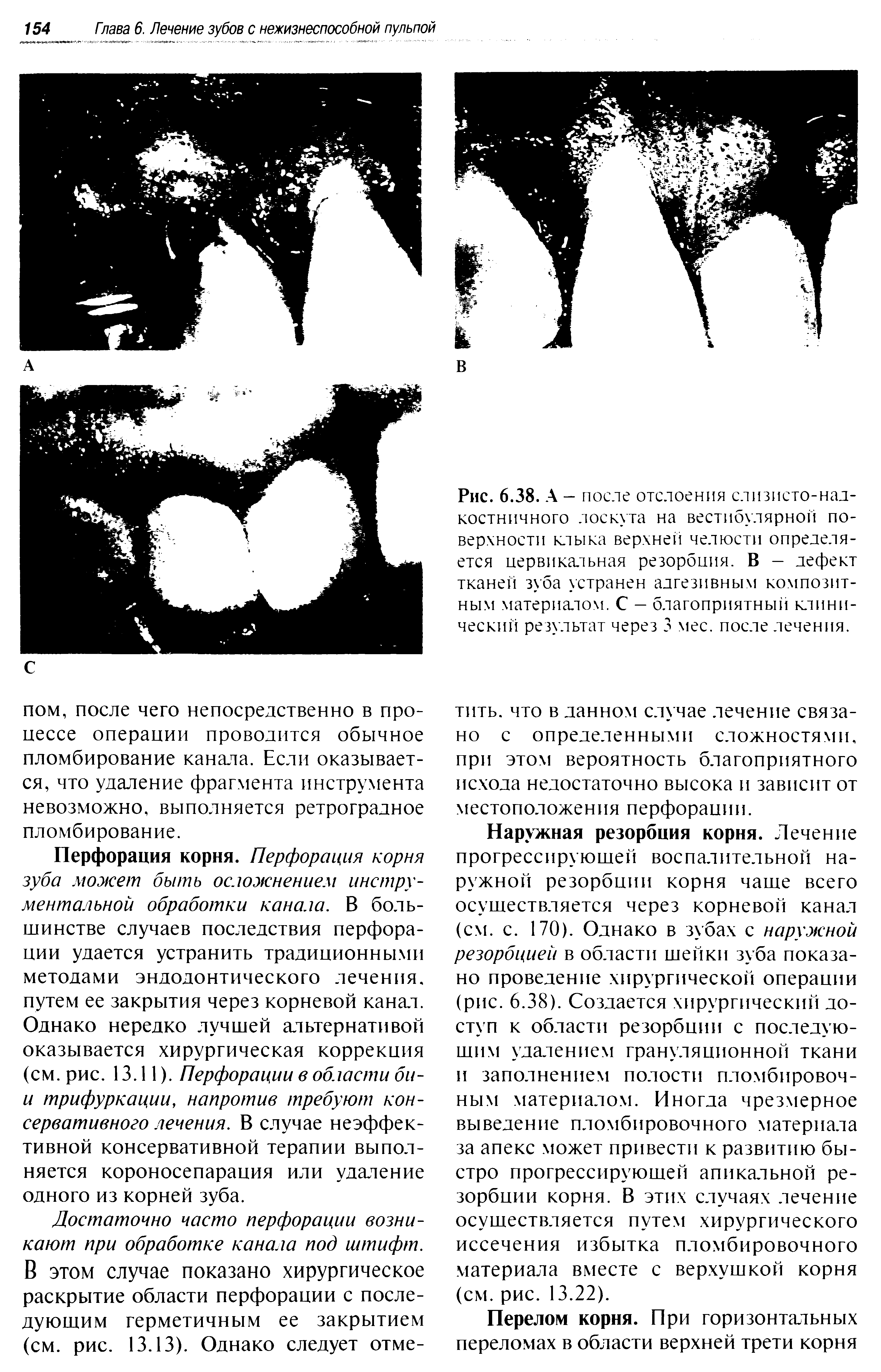 Рис. 6.38. А - после отслоения слизисто-надкостничного лоскута на вестибулярной поверхности клыка верхней челюсти определяется цервикальная резорбция. В — дефект тканей зуба устранен адгезивным композитным материалом. С — благоприятный клинический результат через 3 мес. после лечения.