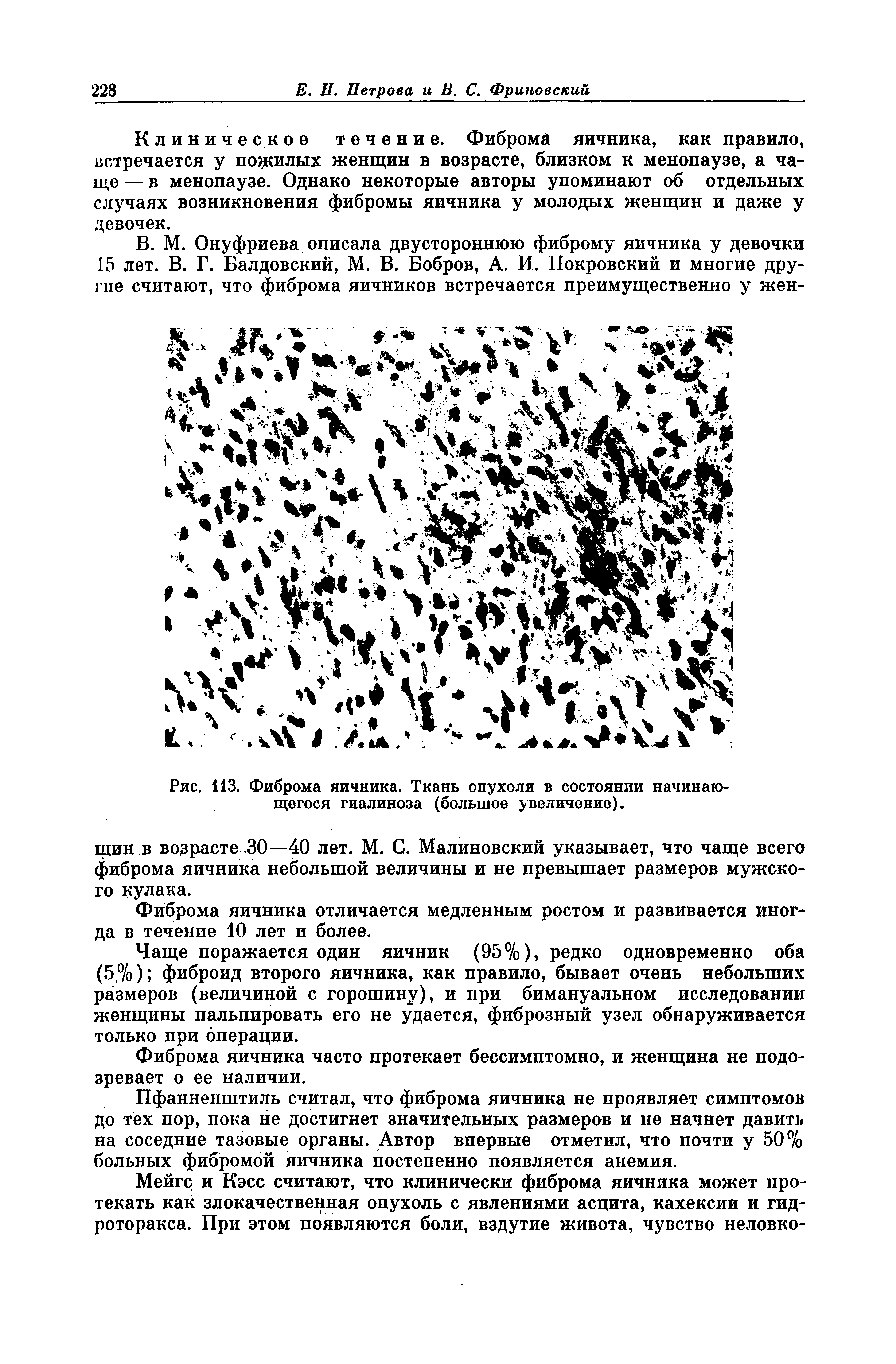 Рис. 113. Фиброма яичника. Ткань опухоли в состоянии начинающегося гиалиноза (большое увеличение).