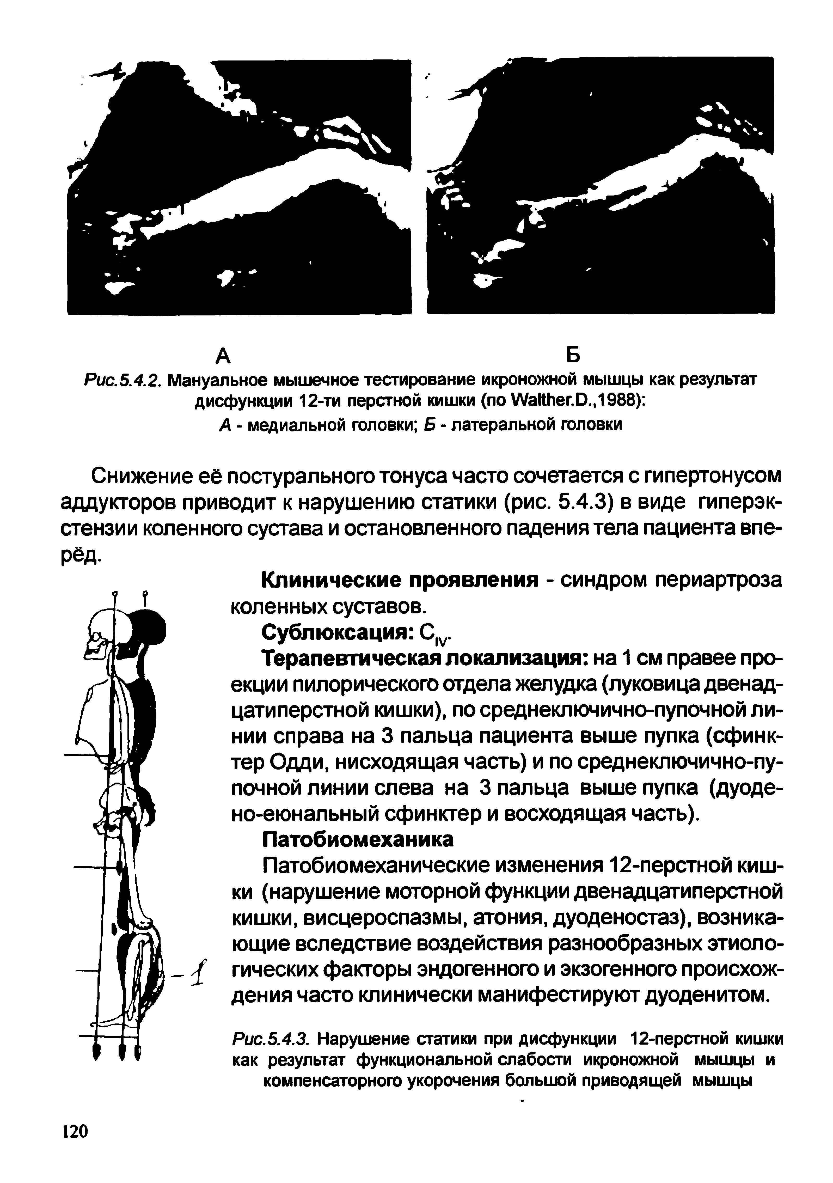 Рис.5.4.2. Мануальное мышечное тестирование икроножной мышцы как результат дисфункции 12-ти перегной кишки (по №а1№ег.О.,1988) А - медиальной головки Б - латеральной головки...