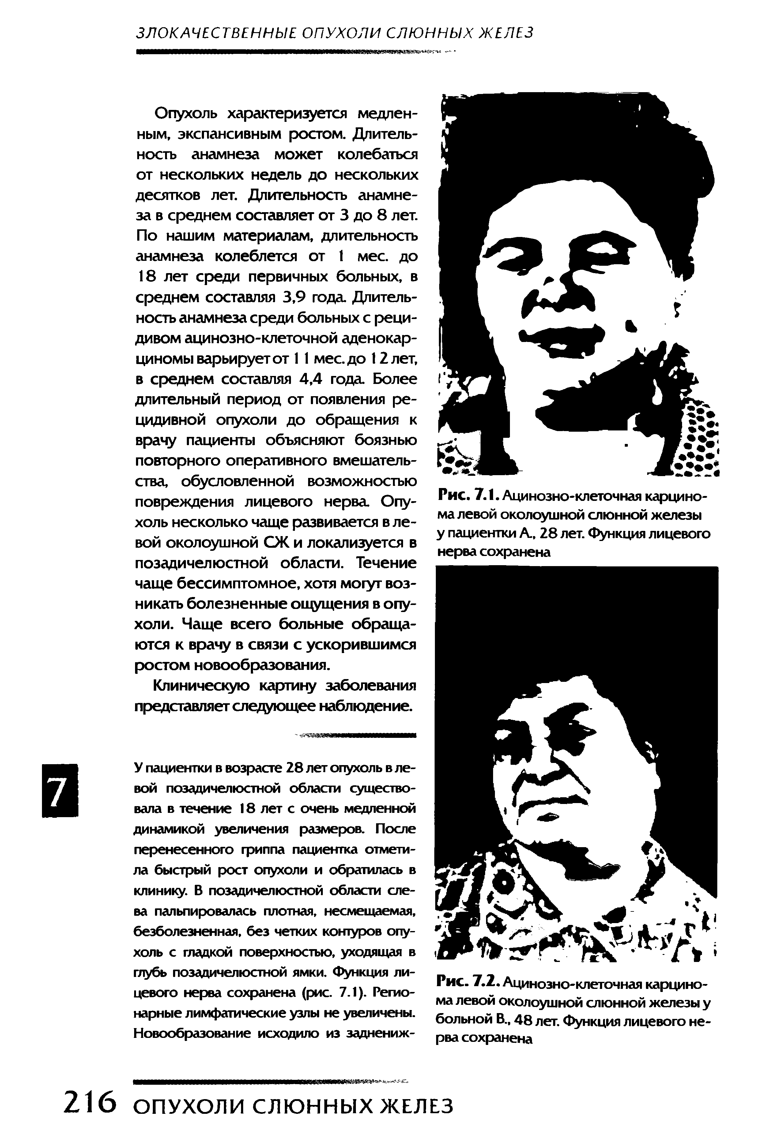 Рис. 7.1. Ацинозно-клеточная карцинома левой околоушной слюнной железы у пациентки А., 28 лет. Функция лицевого нерва сохранена...