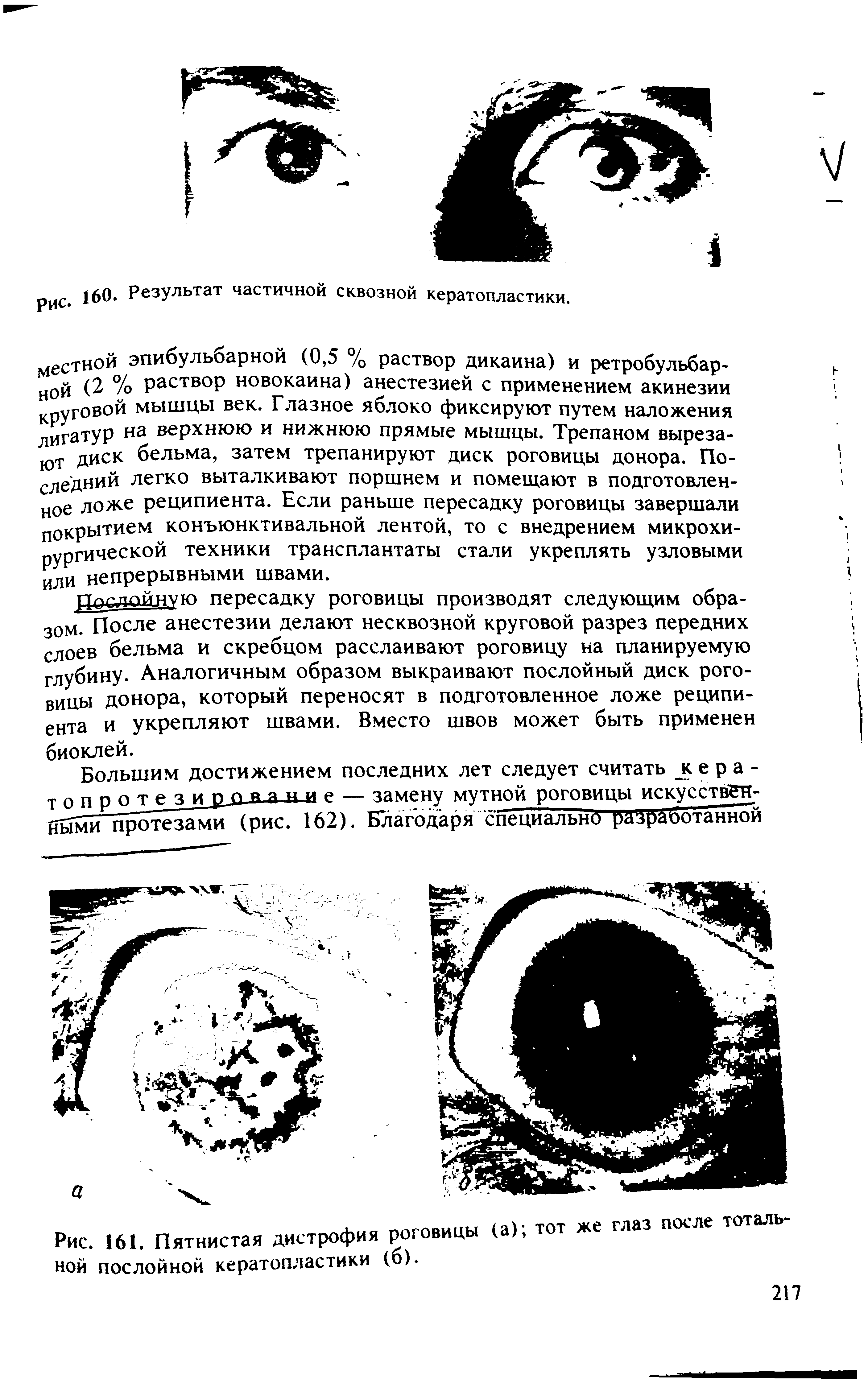 Рис. 161. Пятнистая дистрофия роговицы (а) тот же глаз после тоталъ-ной послойной кератопластики (б).