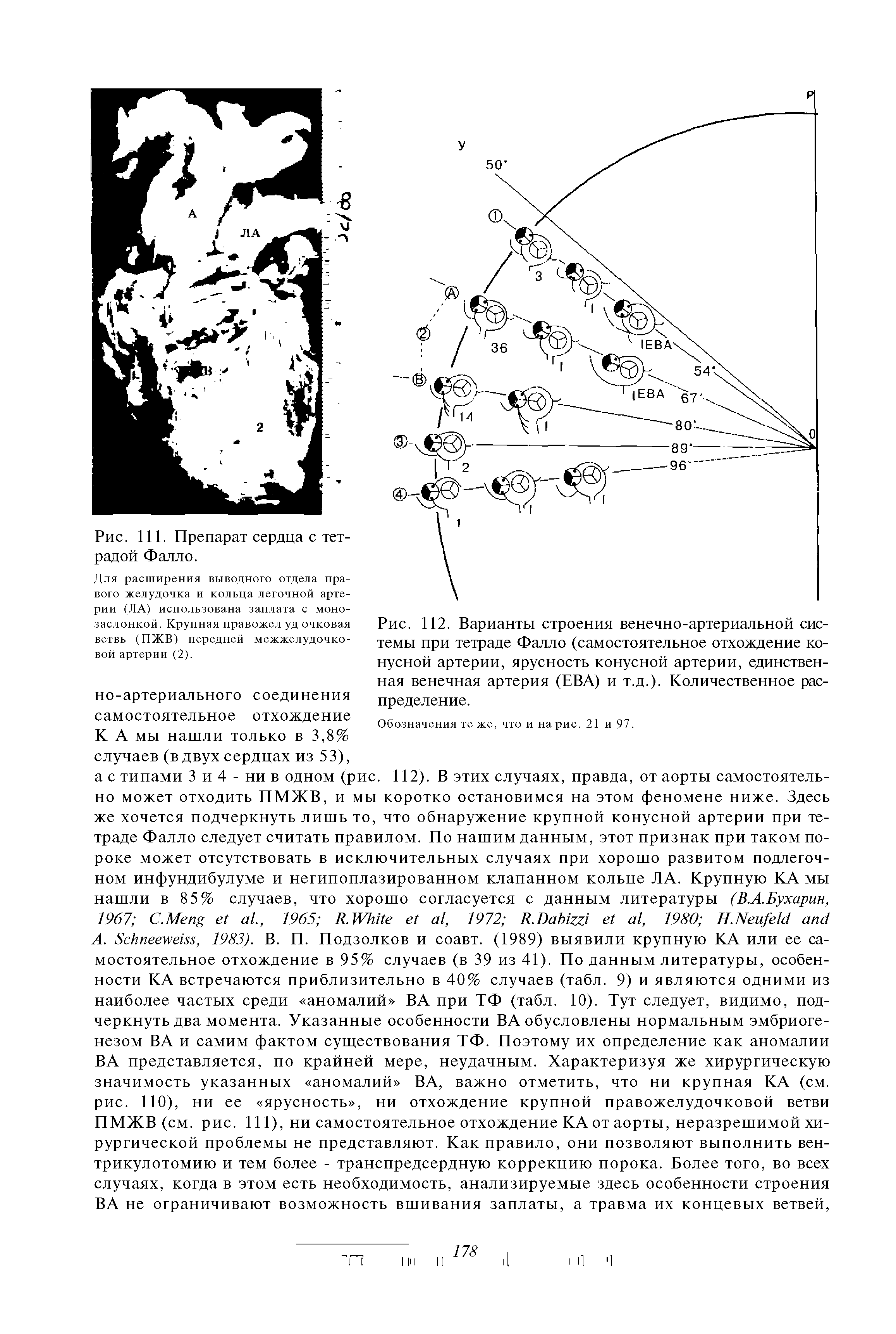 Рис. 112. Варианты строения венечно-артериальной системы при тетраде Фалло (самостоятельное отхождение конусной артерии, ярусность конусной артерии, единственная венечная артерия (ЕВА) и т.д.). Количественное распределение.