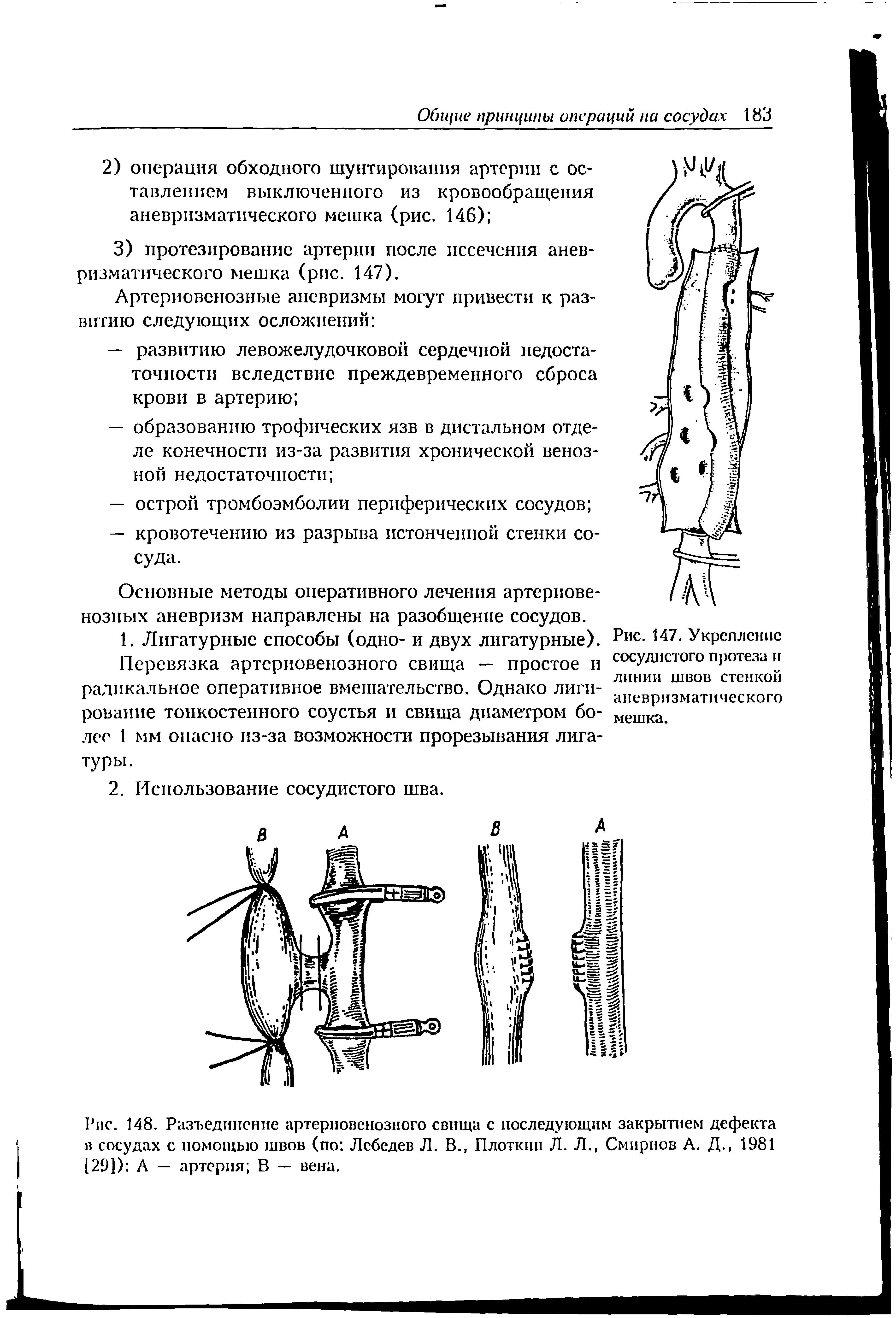 Рис. 148. Разъединение артериовенозного свища с последующим закрытием дефекта в сосудах с помощью швов (по Лебедев Л. В., Плоткин Л. Л., Смирнов А. Д., 1981 129]) А — артерия В — вена.