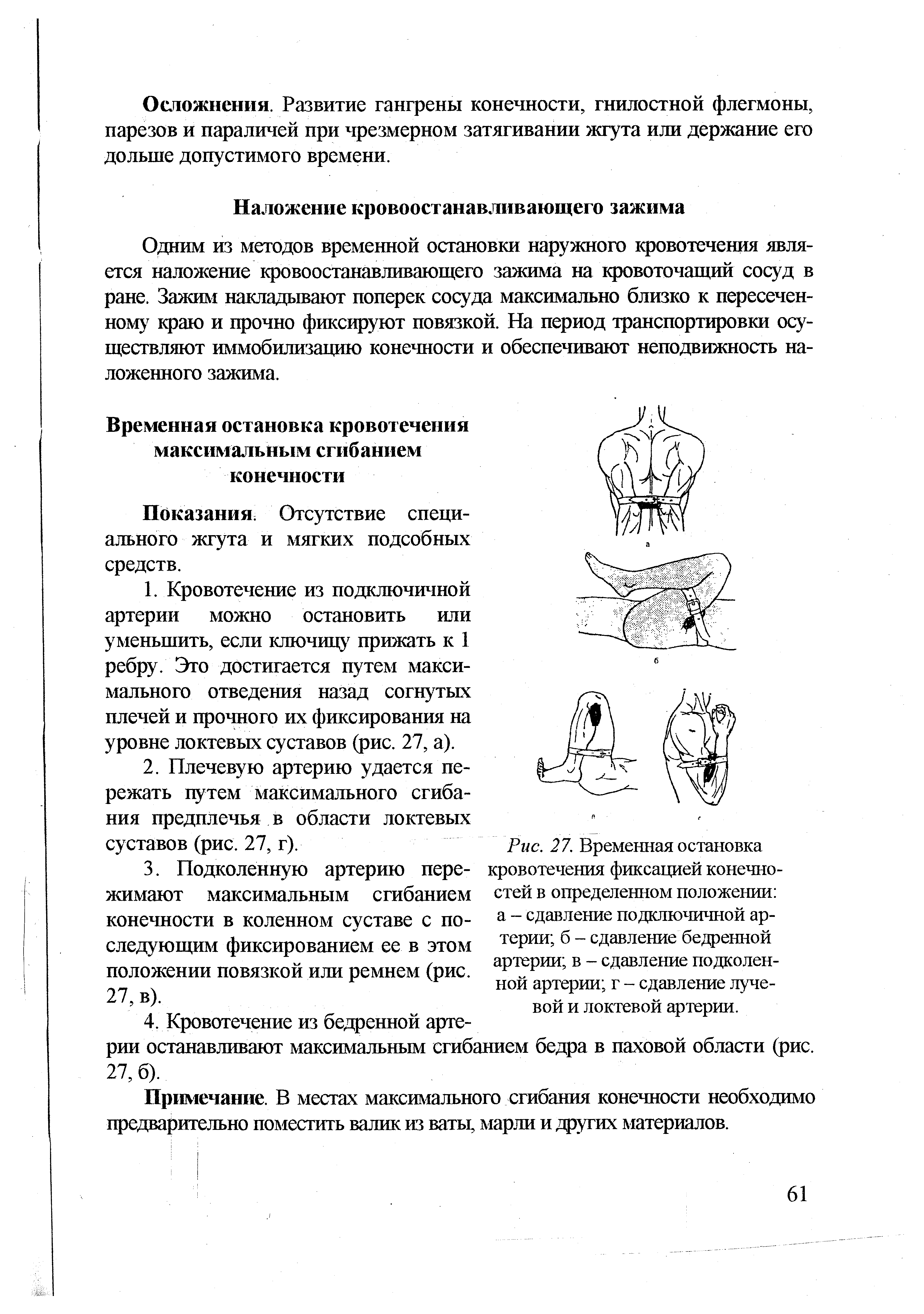 Рис. 27. Временная остановка кровотечения фиксацией конечностей в определенном положении а - сдавление подключичной артерии б - сдавление бедренной артерии в - сдавление подколенной артерии г - сдавление лучевой и локтевой артерии.