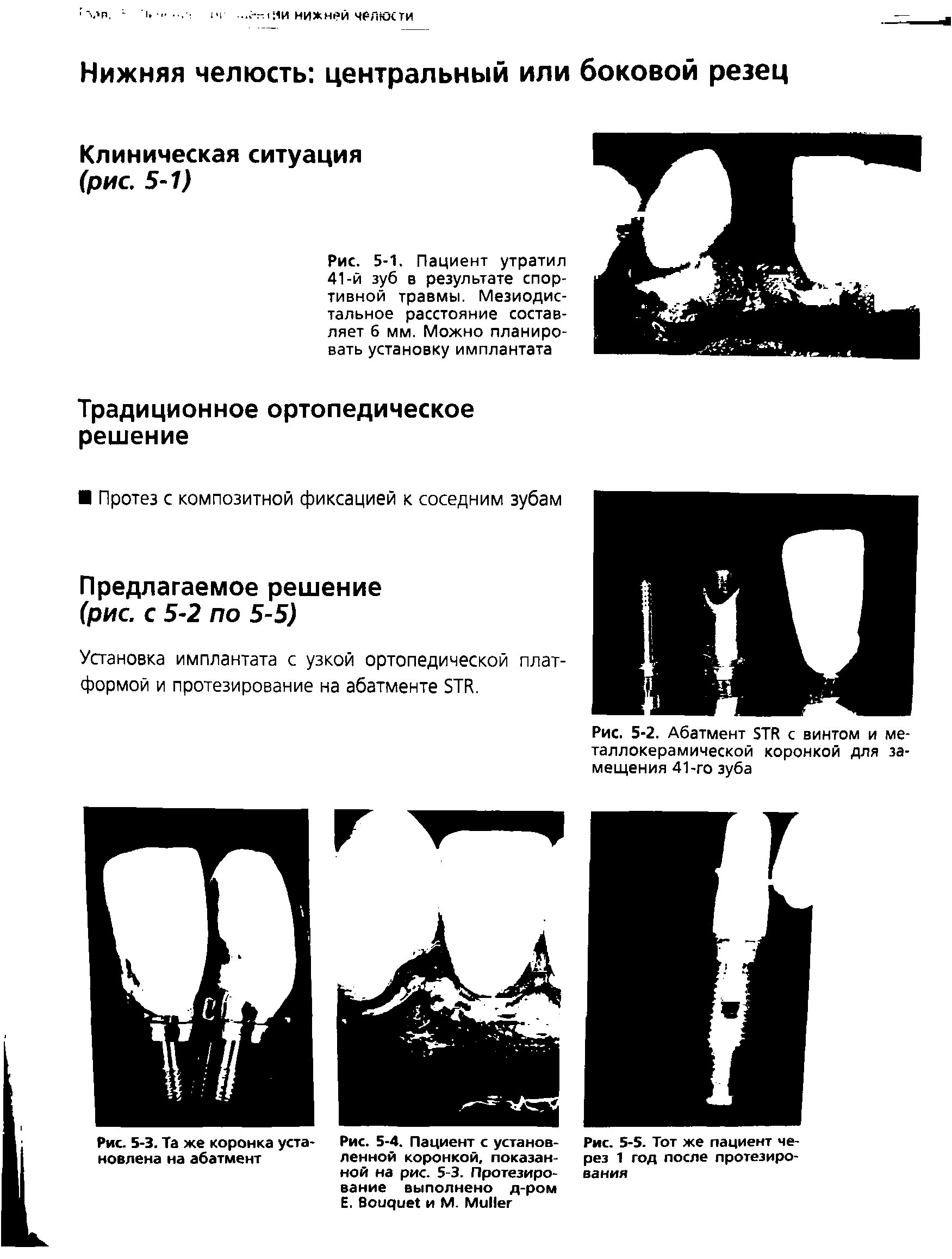 Рис. 5-1. Пациент утратил 41-й зуб в результате спортивной травмы. Мезиодис-тальное расстояние составляет 6 мм. Можно планировать установку имплантата...