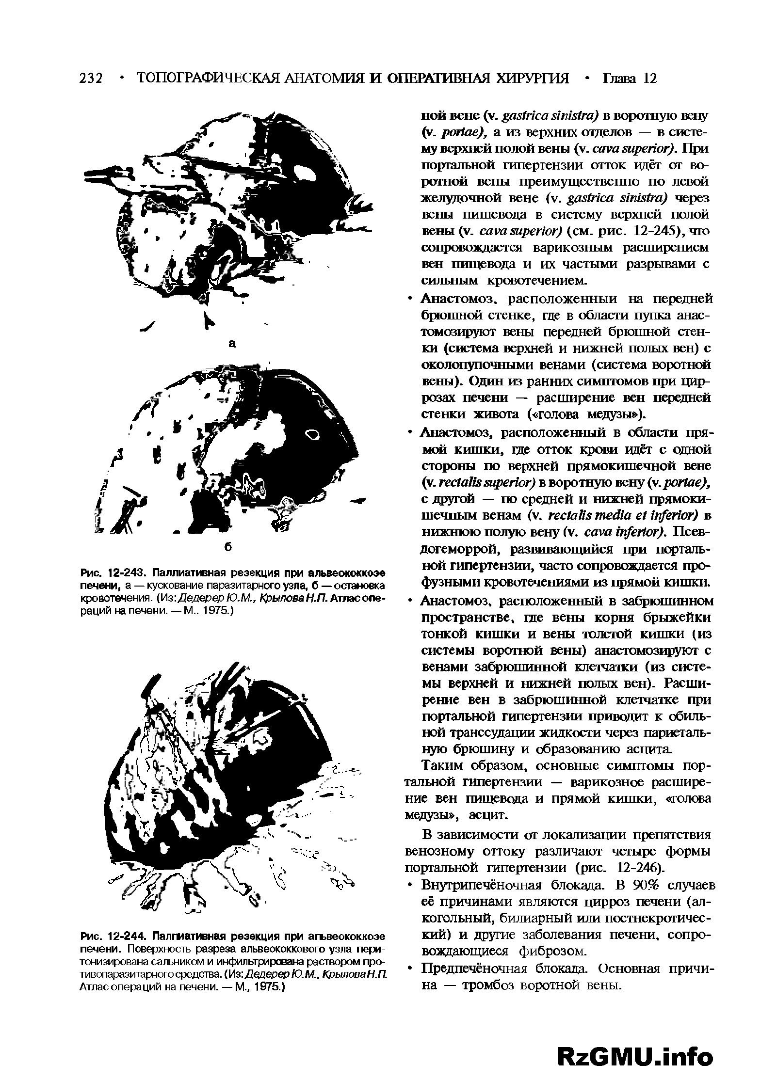 Рис. 12-244. Палгиативная резекция при агъвеококкозе печени. Поверхность разреза альвеококкового узла пери-тонизирована сальником и инфильтрирована раствором про-тивопаразитарного средства. ( Лз Дедерер Ю.М., КрыловаН.П. Атлас операций на печени. — М., 1975.)...