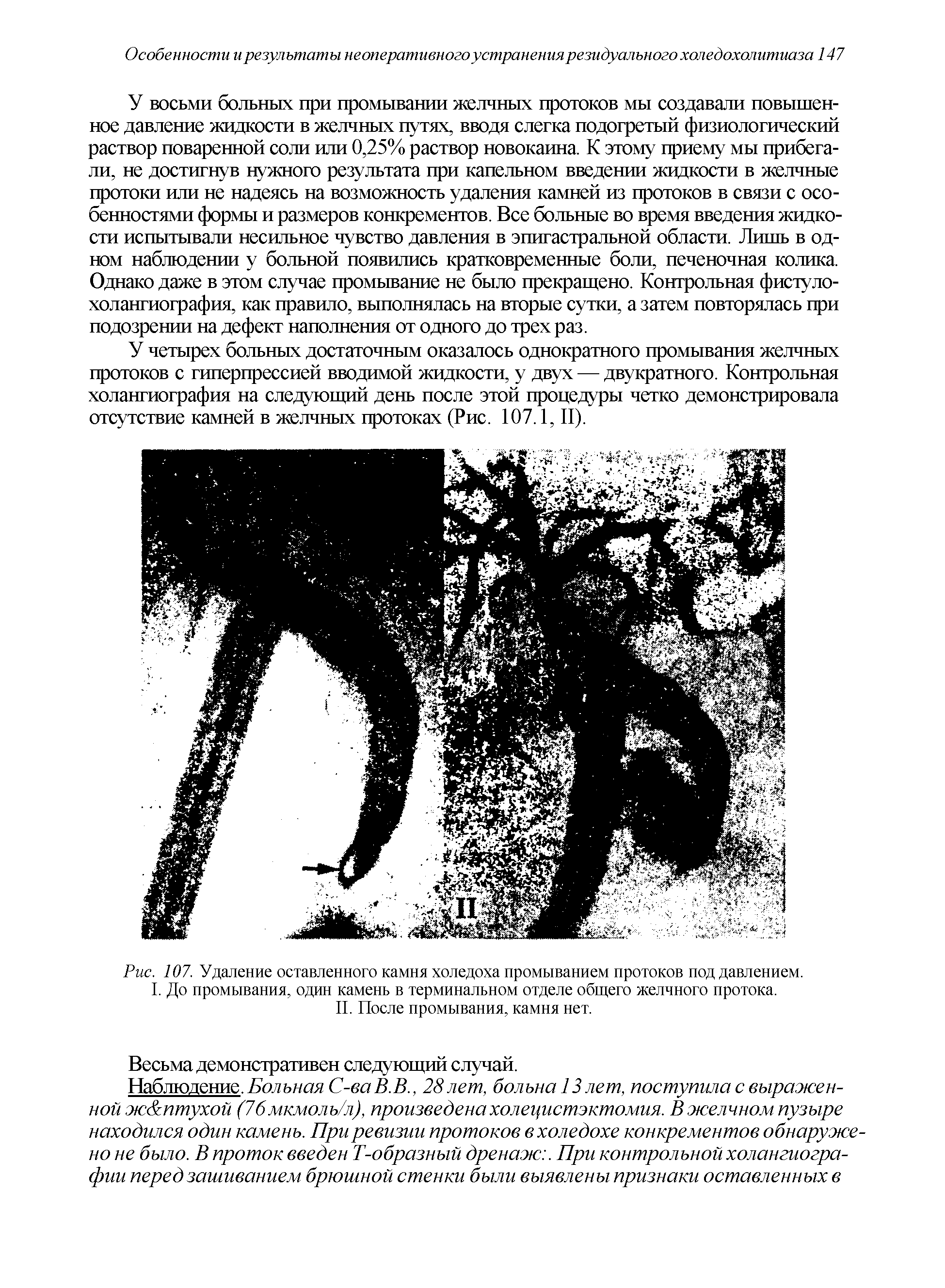 Рис. 107. Удаление оставленного камня холедоха промыванием протоков под давлением. I. До промывания, один камень в терминальном отделе общего желчного протока. II. После промывания, камня нет.