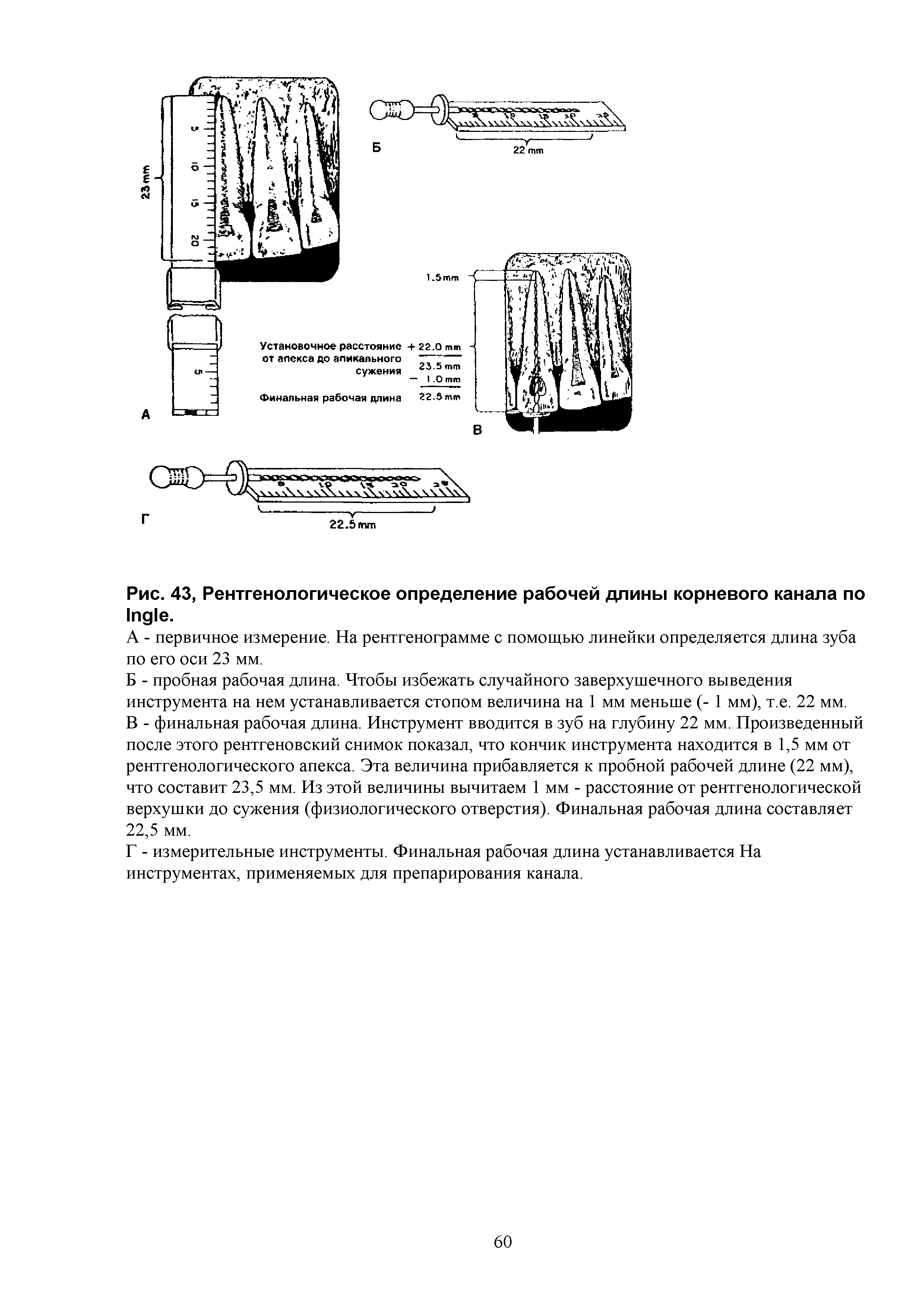 Рис. 43, Рентгенологическое определение рабочей длины корневого канала по I .