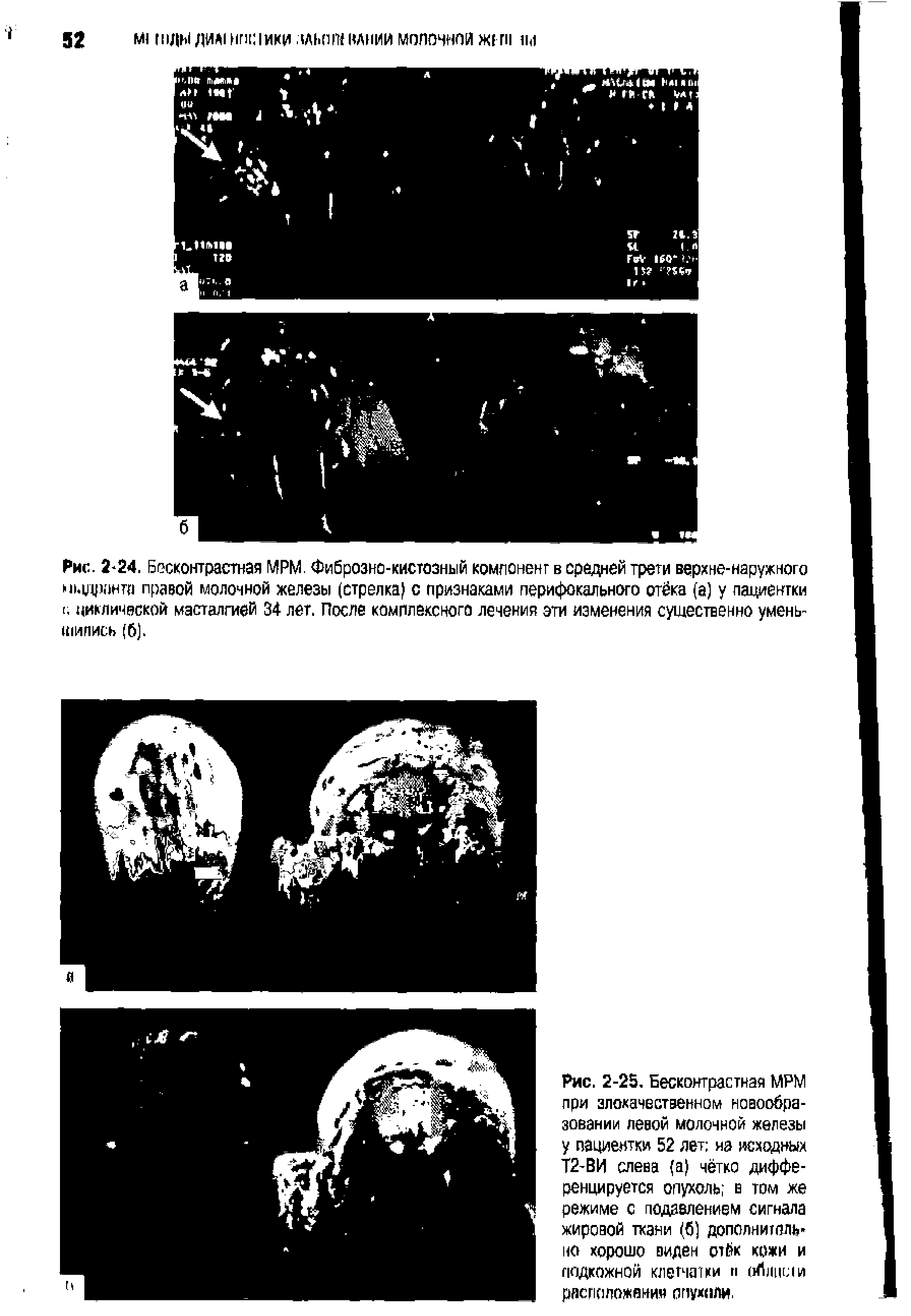 Рис. 2-24. Б неконтрастная МРМ Фиброзно-кистозный компонент в средней трети верхне-наружного п.рчюнта правой молочной железы (стрелка) с признаками перифокального отёка (а) у пациентки I. циклической масталгией 34 лет. После комплексного лечения эти изменения существенно уменьшились (б).