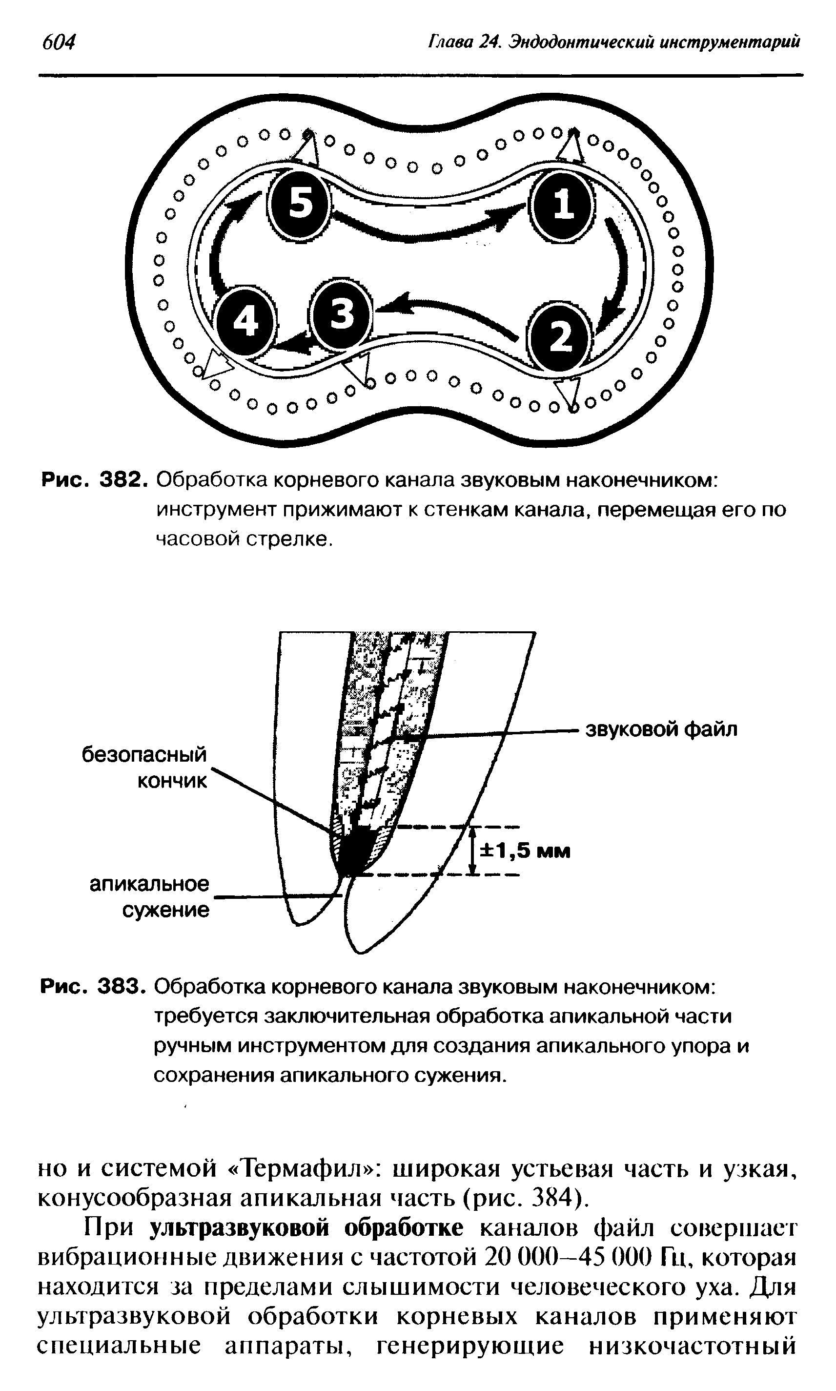 Рис. 383. Обработка корневого канала звуковым наконечником требуется заключительная обработка апикальной части ручным инструментом для создания апикального упора и сохранения апикального сужения.