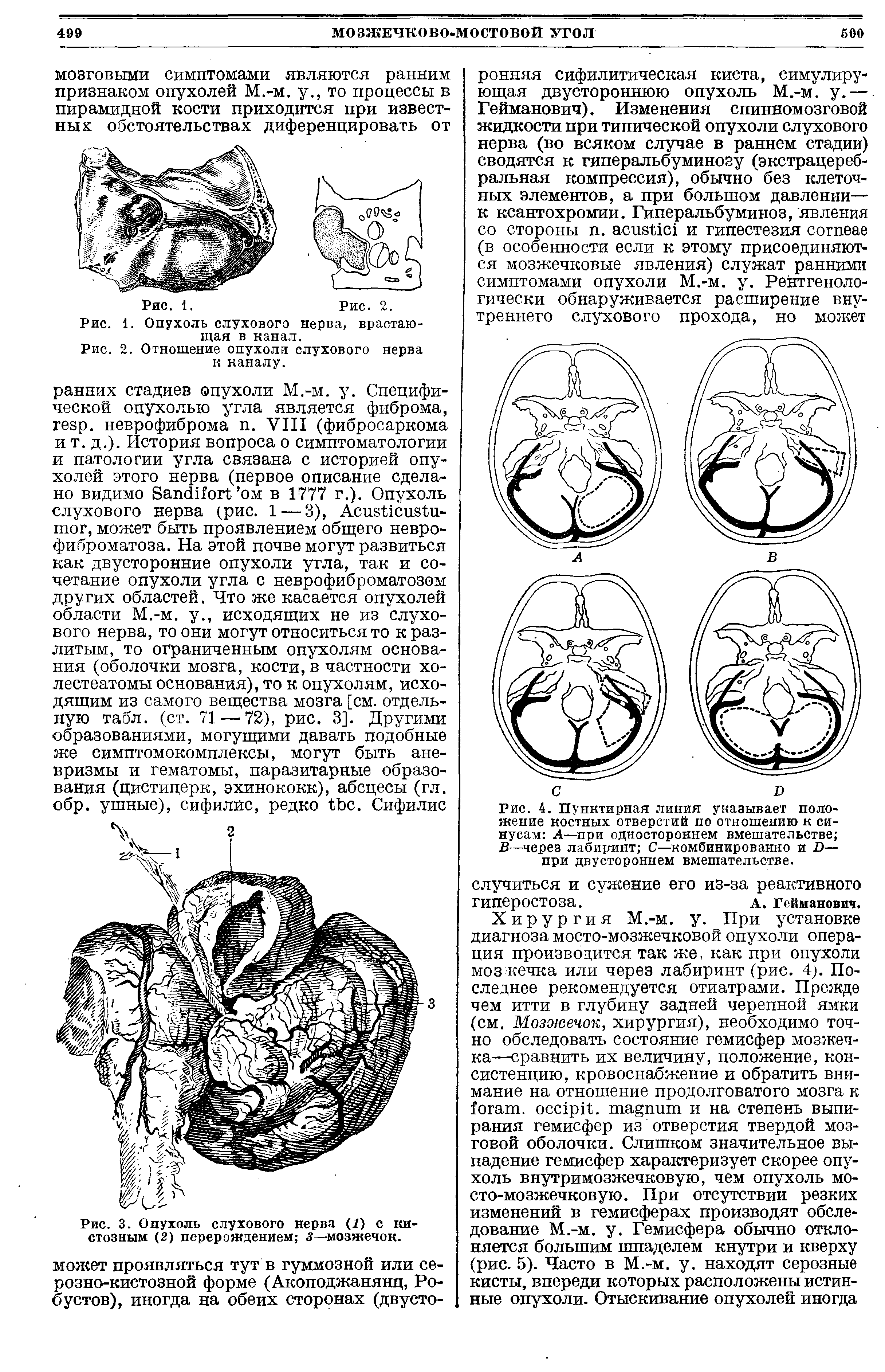 Рис. 3. Опухоль слухового нерва (7) с кистозным (2) перерождением з—мозжечок.