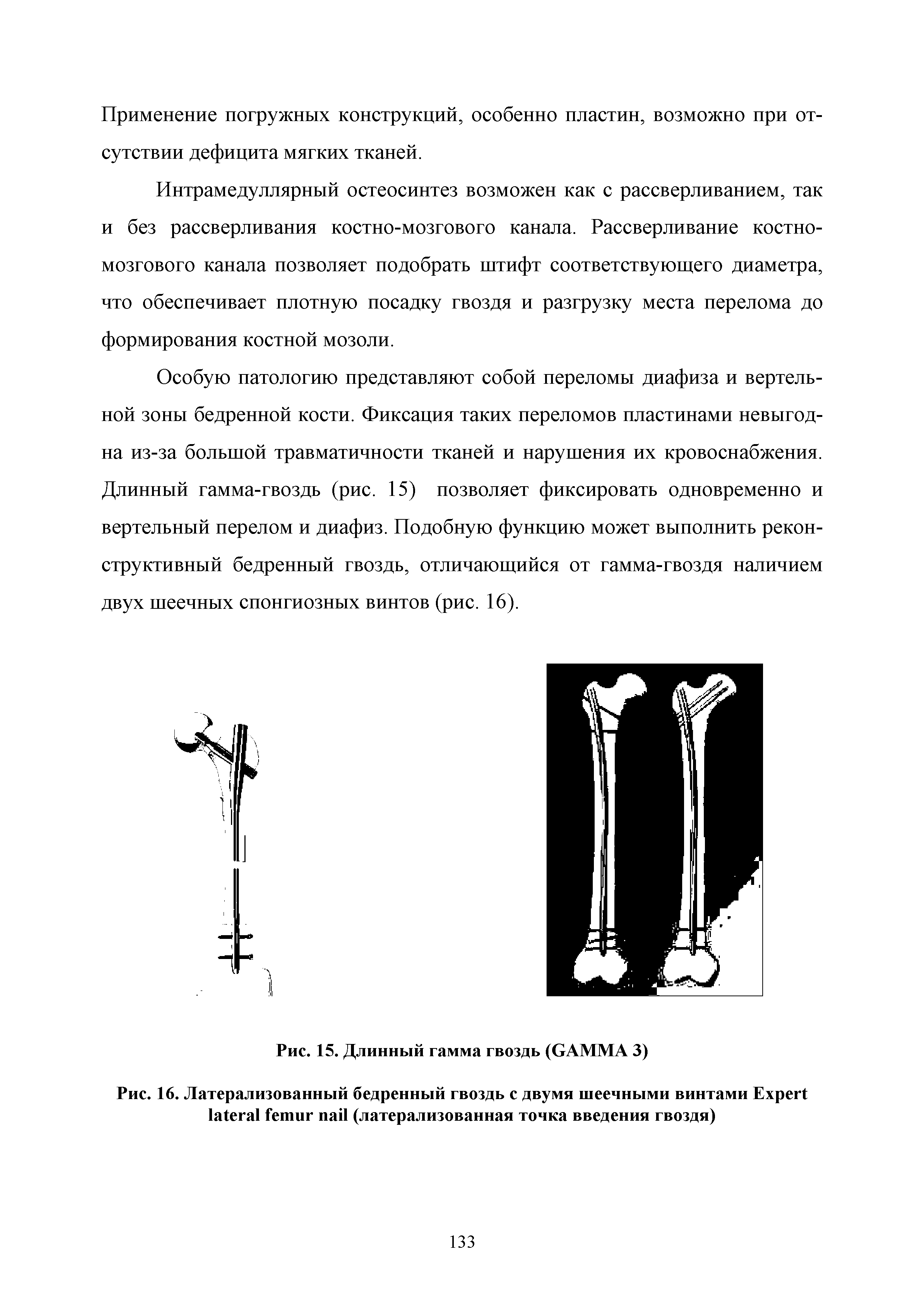 Рис. 16. Латерализованный бедренный гвоздь с двумя шеечными винтами E (латерализованная точка введения гвоздя)...