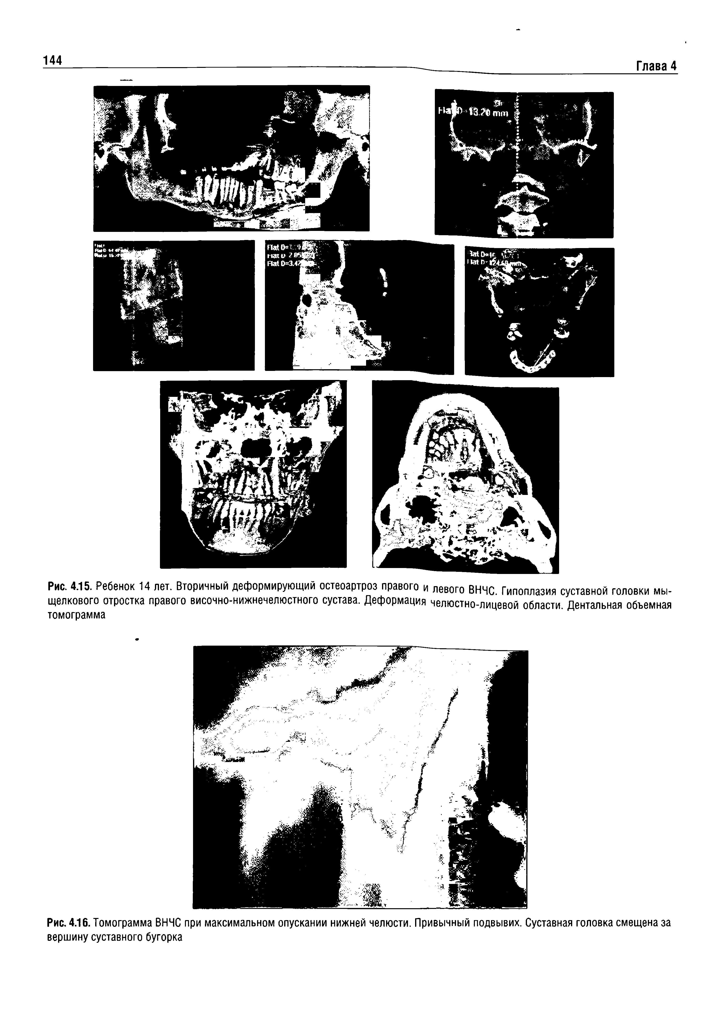 Рис. 4.15. Ребенок 14 лет. Вторичный деформирующий остеоартроз правого и левого ВНЧС. Гипоплазия суставной головки мыщелкового отростка правого височно-нижнечелюстного сустава. Деформация челюстно-лицевой области. Дентальная объемная томограмма...
