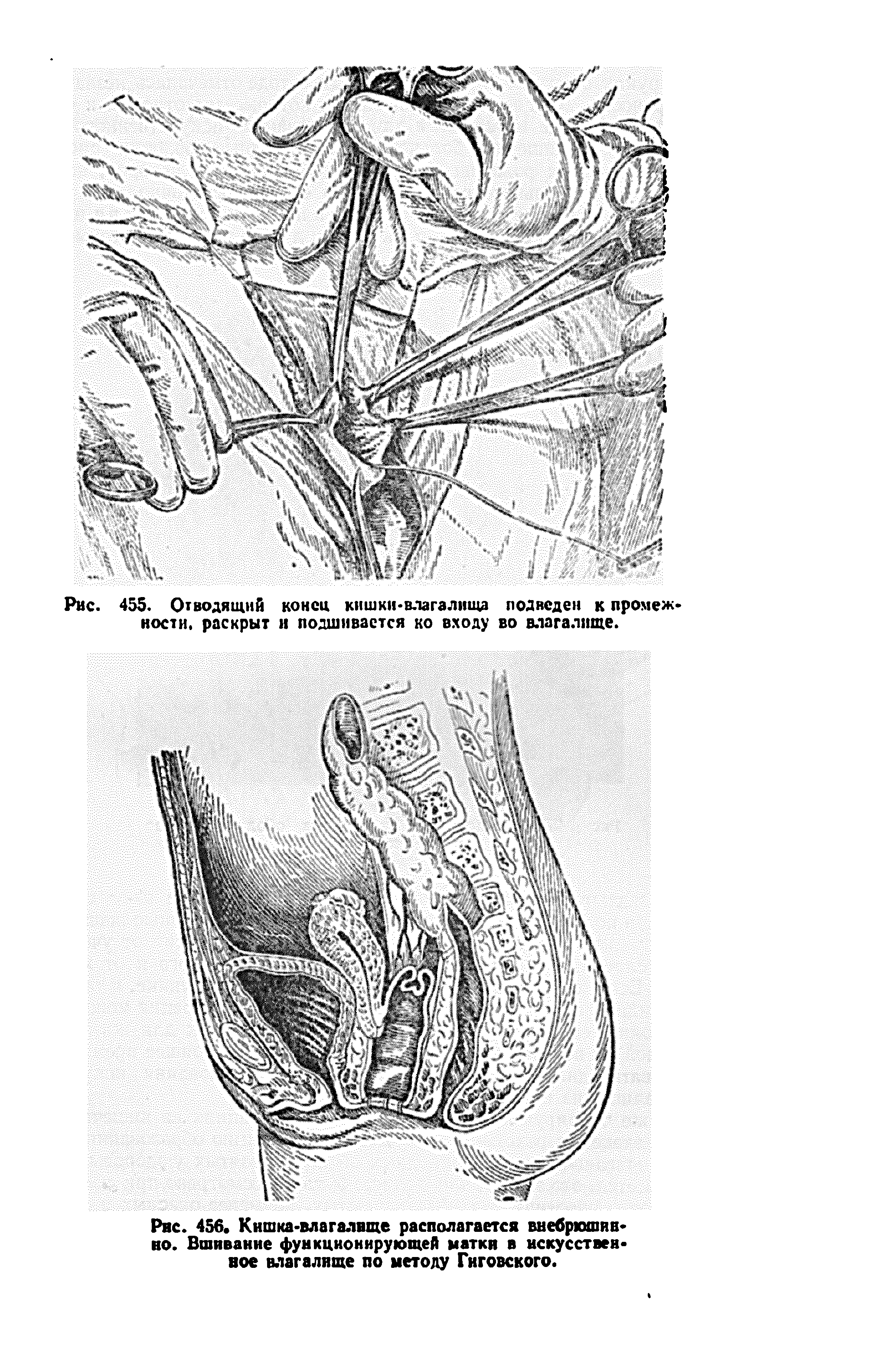 Рис. 456. Кишка-влагалище располагается внебрюшин но. Вшивание функционирующей матки в искусственное влагалище по методу Гиговского.