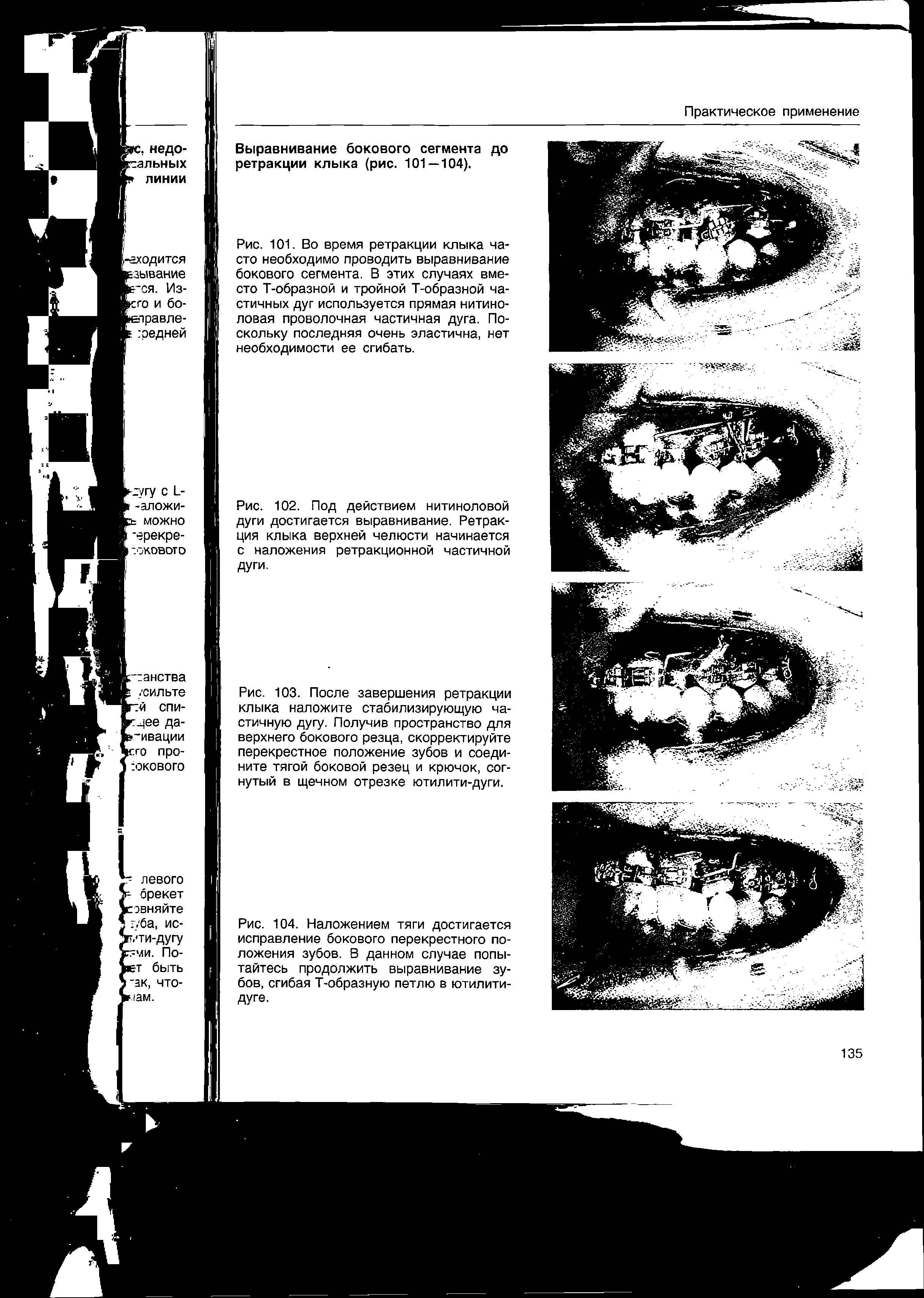 Рис. 102. Под действием нитиноловой дуги достигается выравнивание. Ретракция клыка верхней челюсти начинается с наложения ретракционной частичной дуги.