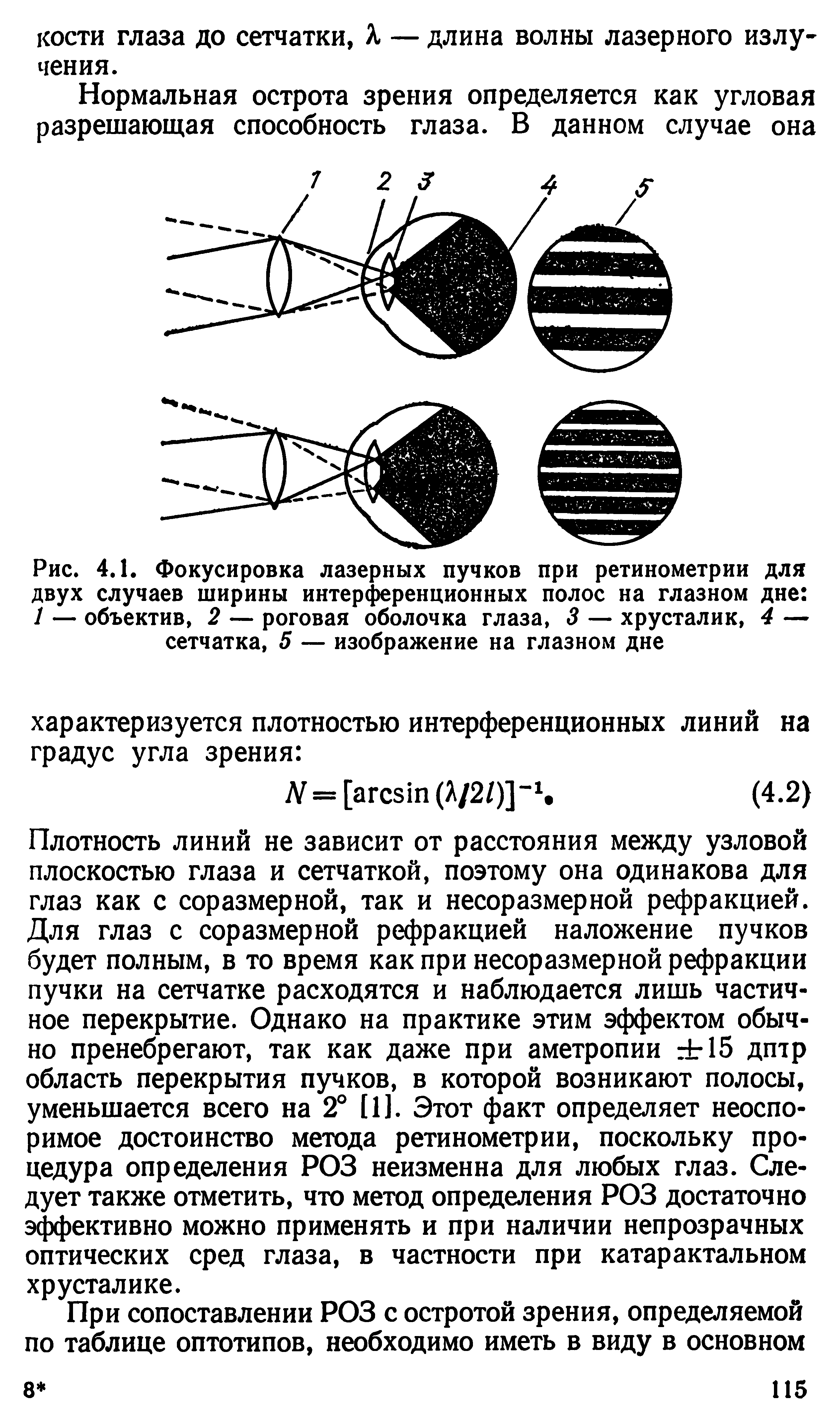 Рис. 4.1. Фокусировка лазерных пучков при ретинометрии для двух случаев ширины интерференционных полос на глазном дне / — объектив, 2 — роговая оболочка глаза, 3 — хрусталик, 4 — сетчатка, 5 — изображение на глазном дне...