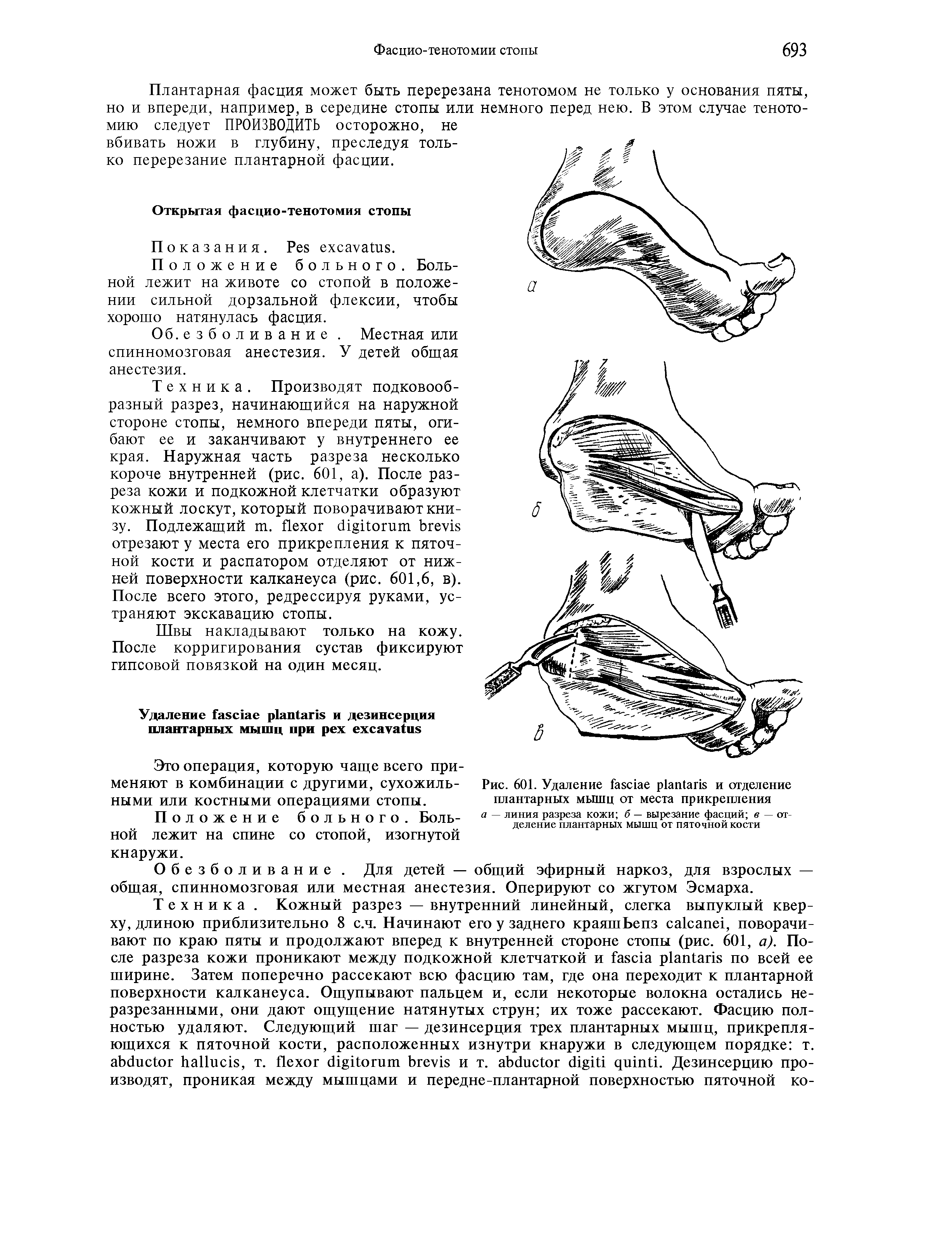 Рис. 601. Удаление и отделение плантарных мышц от места прикрепления...