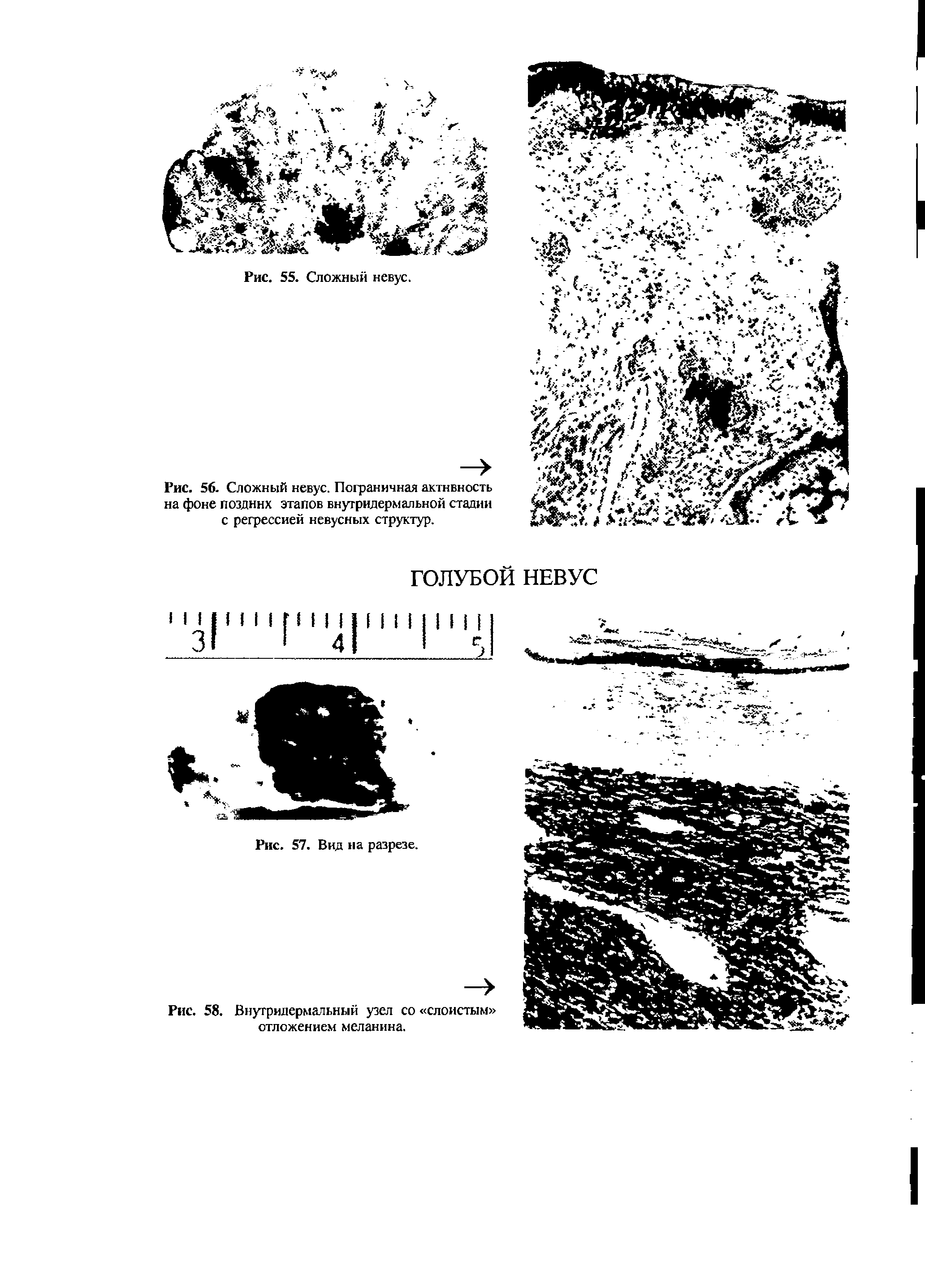 Рис. 56. Сложный невус. Пограничная активность на фоне поздннх этапов внутридермальной стадии с регрессией невусных структур.