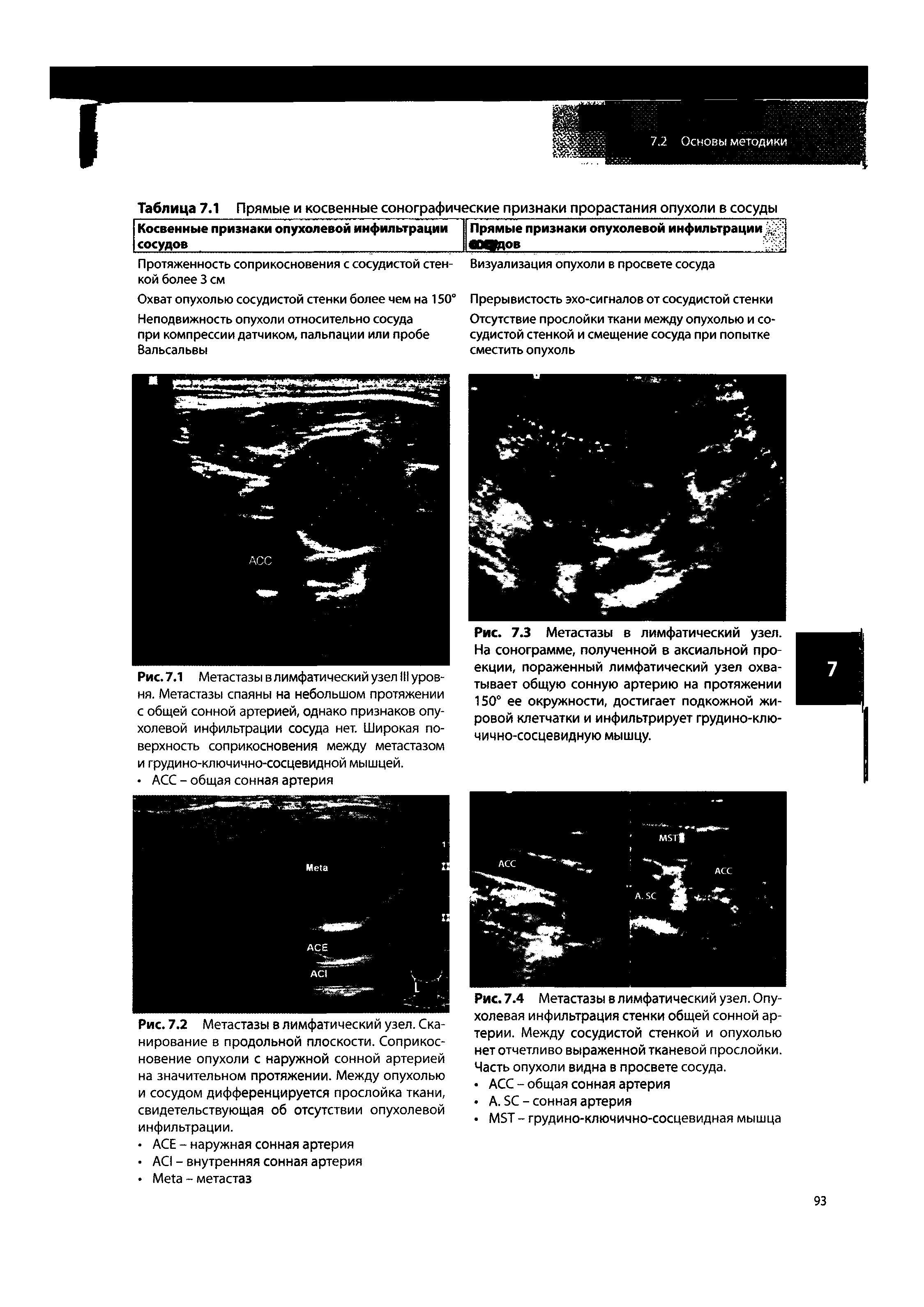 Рис. 7.4 Метастазы в лимфатический узел. Опухолевая инфильтрация стенки общей сонной артерии. Между сосудистой стенкой и опухолью нет отчетливо выраженной тканевой прослойки. Часть опухоли видна в просвете сосуда.