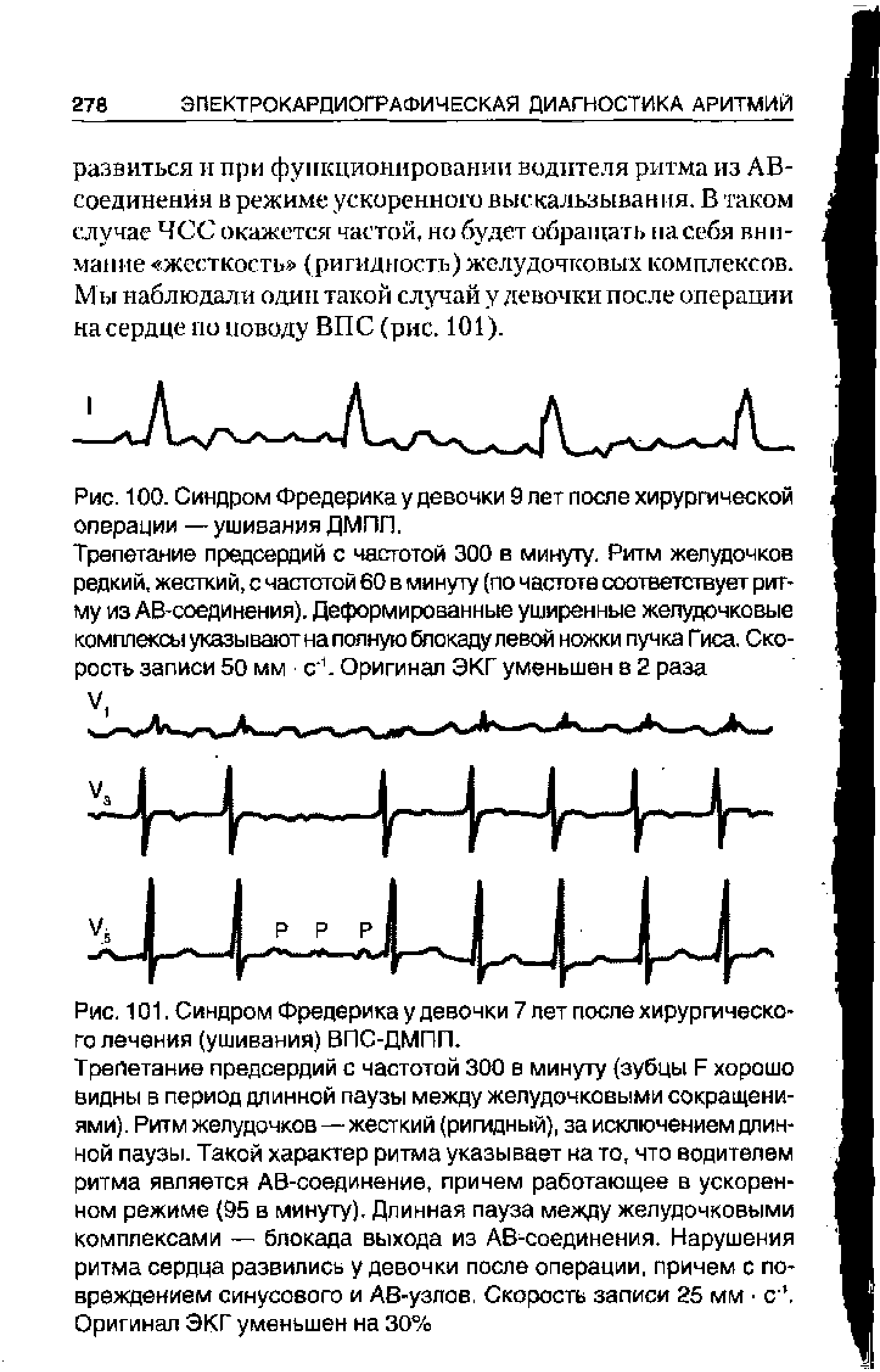 Рис. 101. Синдром Фредерика у девочки 7 пет после хирургического лечения (ушивания) ВПС-ДМПП.