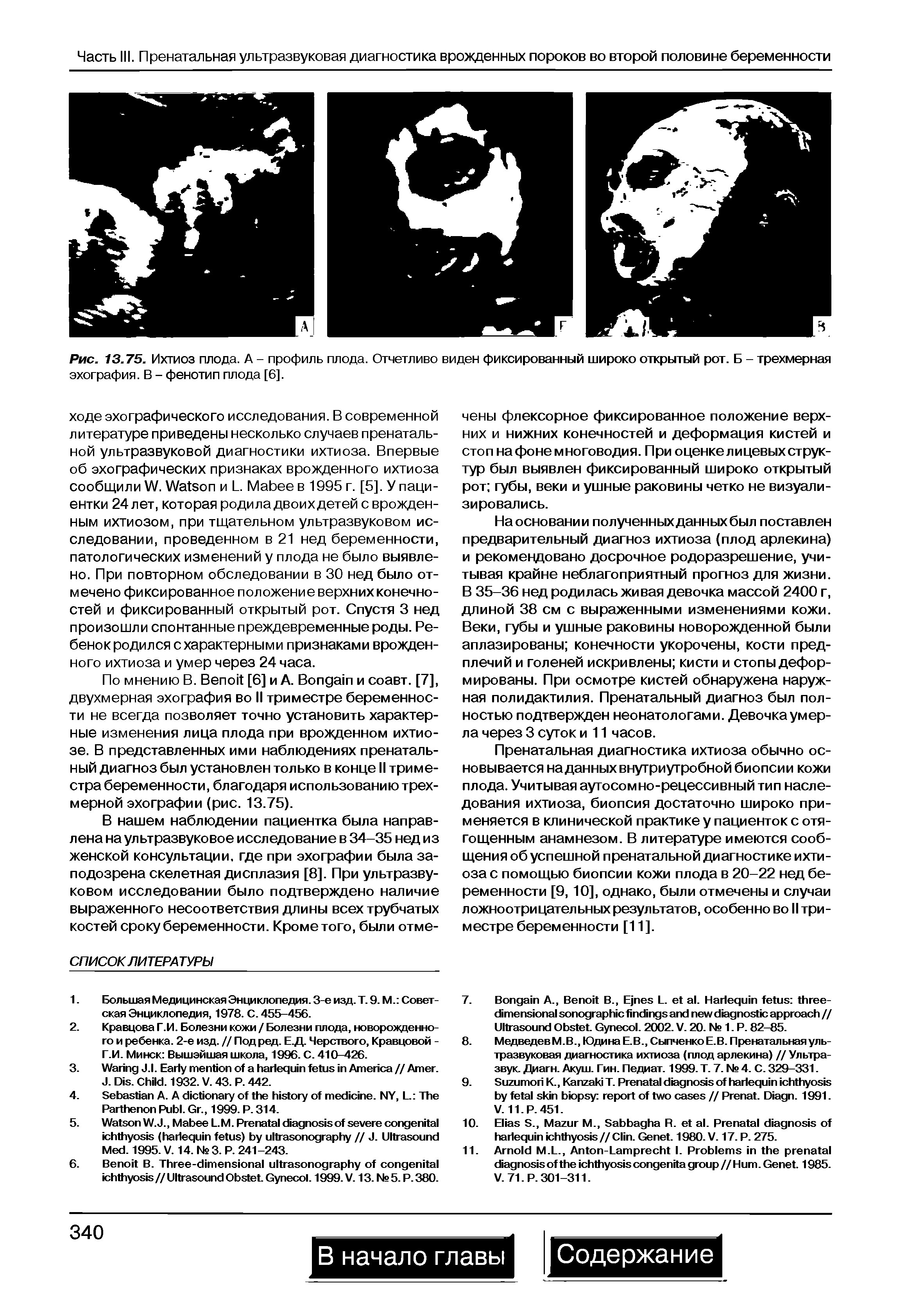 Рис. 13.75. Ихтиоз плода. А - профиль плода. Отчетливо виден фиксированный широко открытый рот. Б - трехмерная эхография. В - фенотип плода [6].