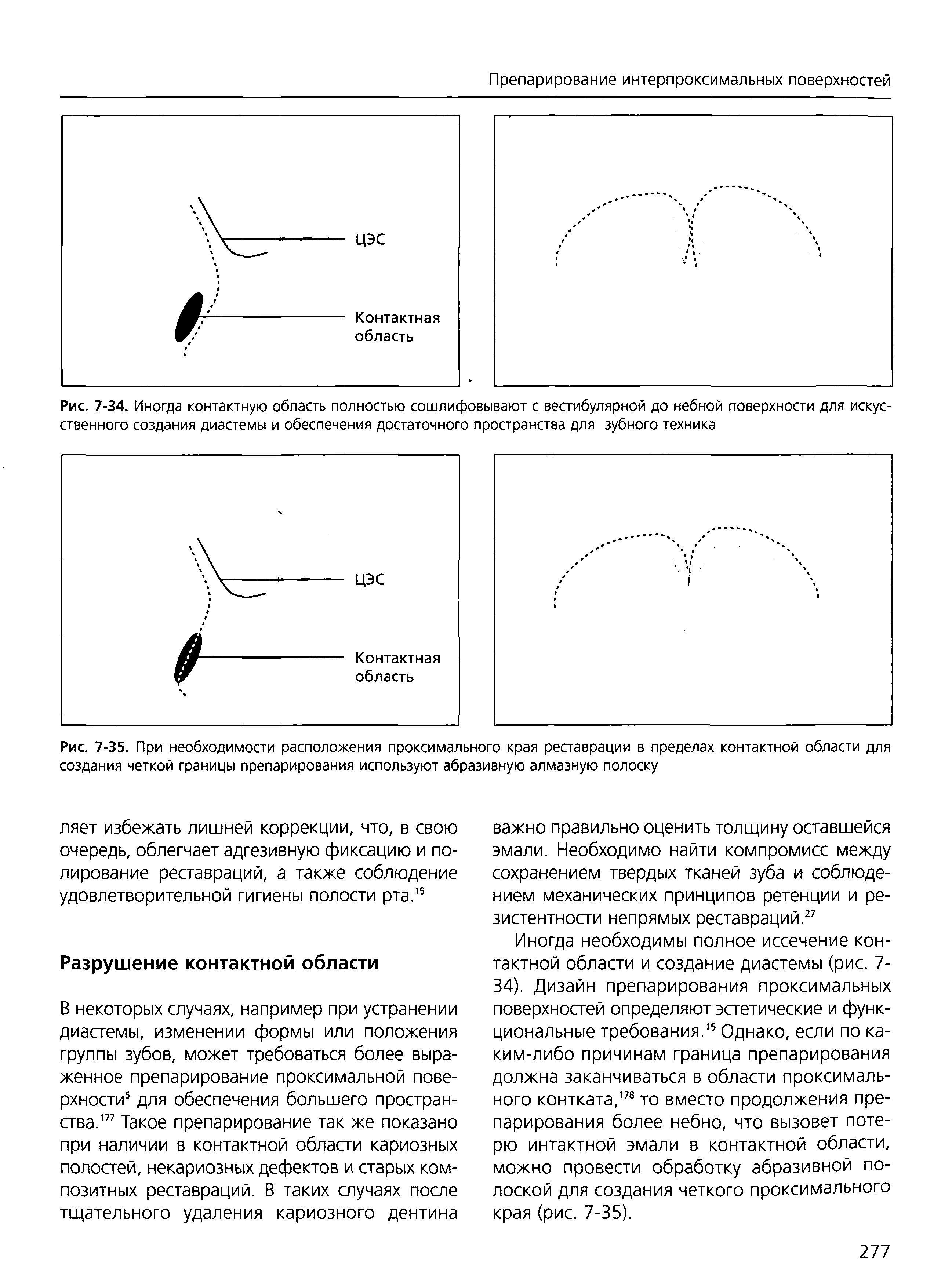 Рис. 7-35. При необходимости расположения проксимального края реставрации в пределах контактной области для создания четкой границы препарирования используют абразивную алмазную полоску...