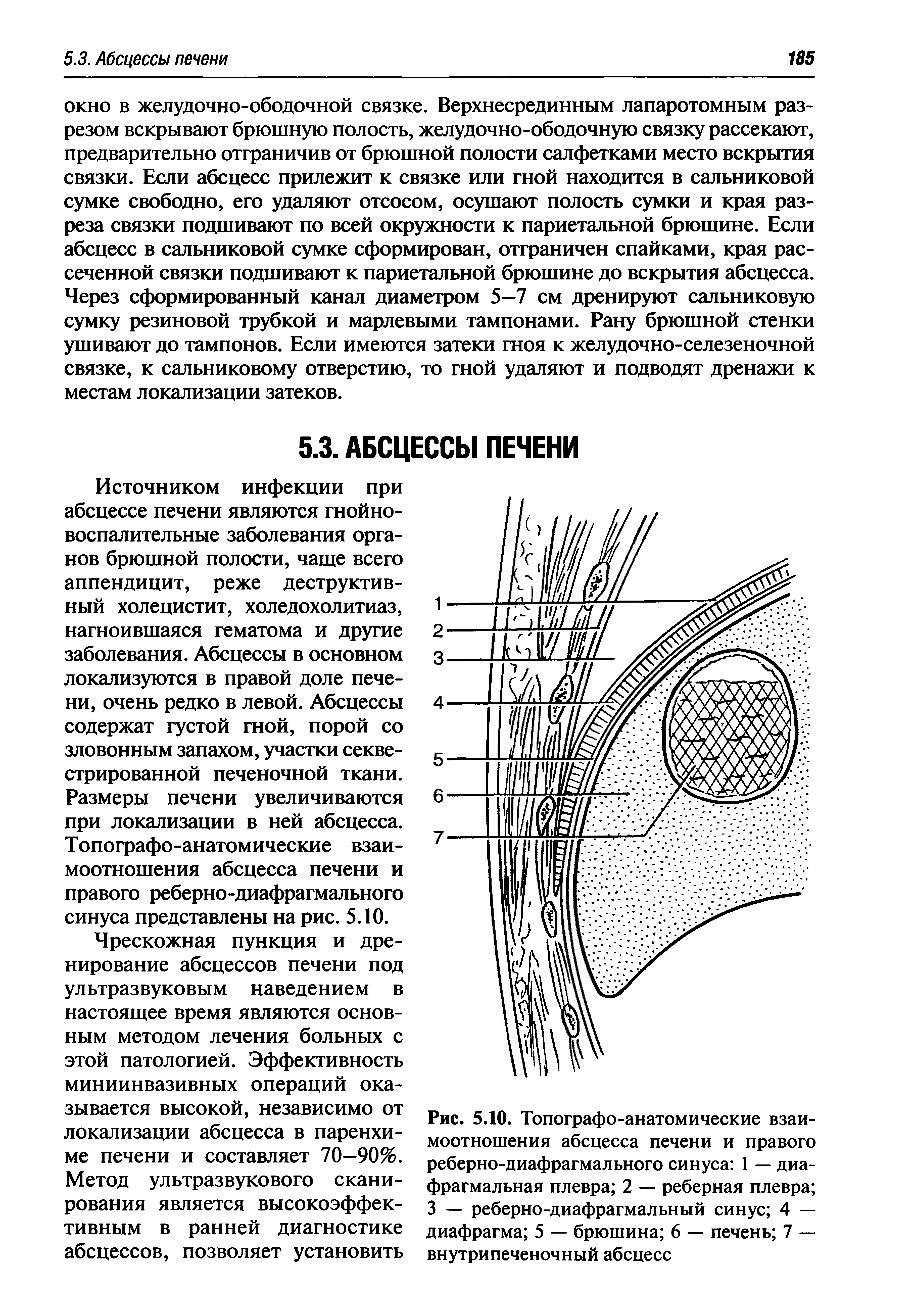 Рис. 5.10. Топографо-анатомические взаимоотношения абсцесса печени и правого реберно-диафрагмального синуса 1 — диафрагмальная плевра 2 — реберная плевра 3 — реберно-диафрагмальный синус 4 — диафрагма 5 — брюшина 6 — печень 7 — внутрипеченочный абсцесс...