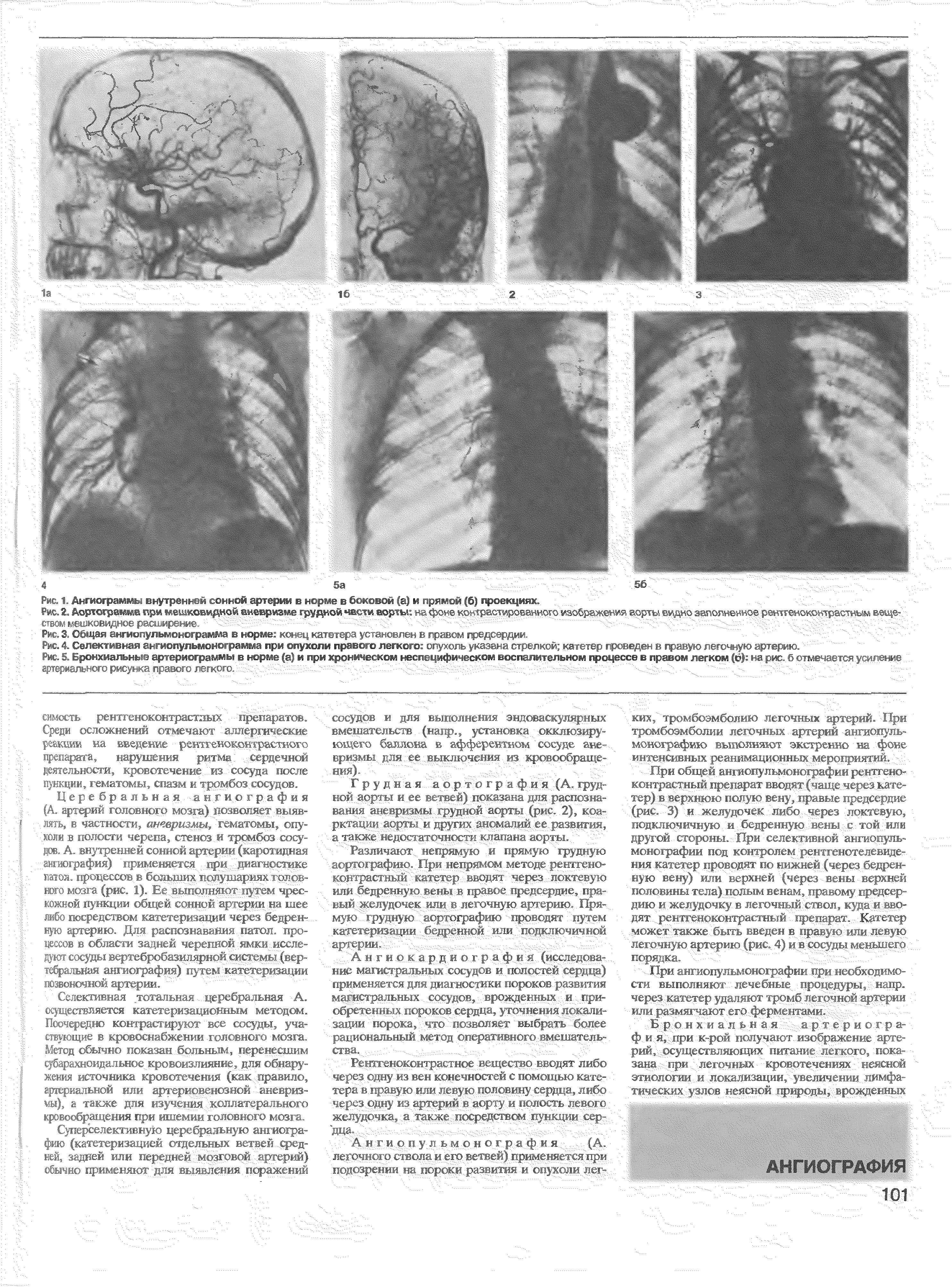 Рис. 5. Бронхиальнь. 1 ар гериограммы в норме (а) и при хроническом неспецифическом воспалительном процессе в правом легком (6) на рис. б отмечается усиление артериального рисунка, правого пеги т ...