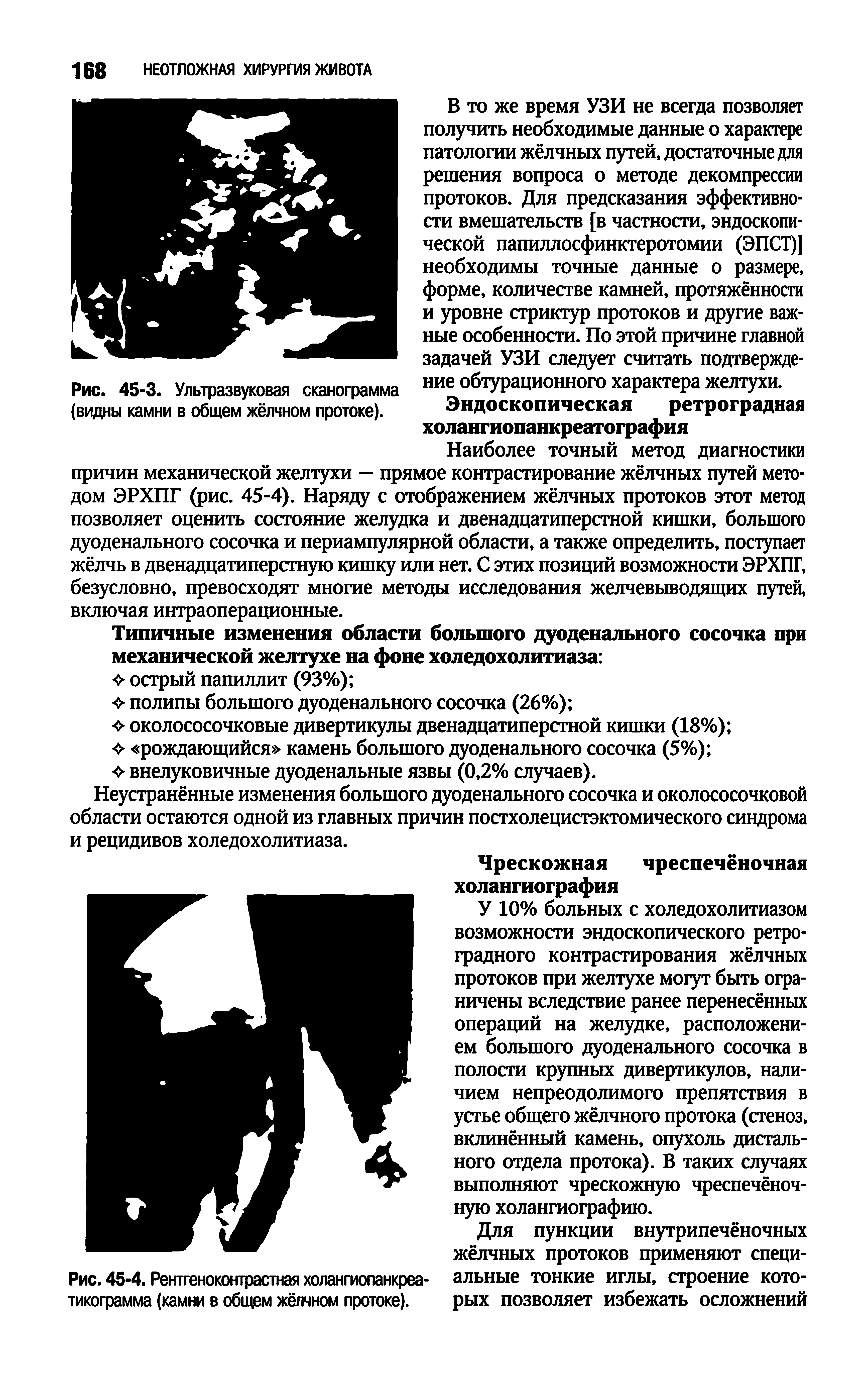 Рис. 45-3. Ультразвуковая сканограмма ние обтурационного характера желтухи, (видны камни в общем жёлчном протоке). Эндоскопическая ретроградная холангиопанкреатография...