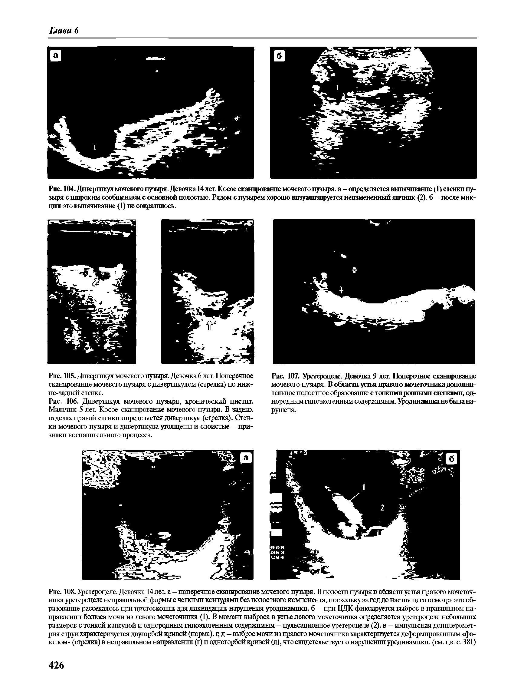 Рис. 104. Дивертпкул мочевого пузыря. Девочка 14 лет. Косое сканирование мочевого пузыря, а - определяется выпячивание (1) стенки пузыря с широким сообщением с основной полостью. Рядом с пузырем хорошо визуализируется неизмененный яичник (2). б - после мик-щгп это выпячивание (1) не сократилось.