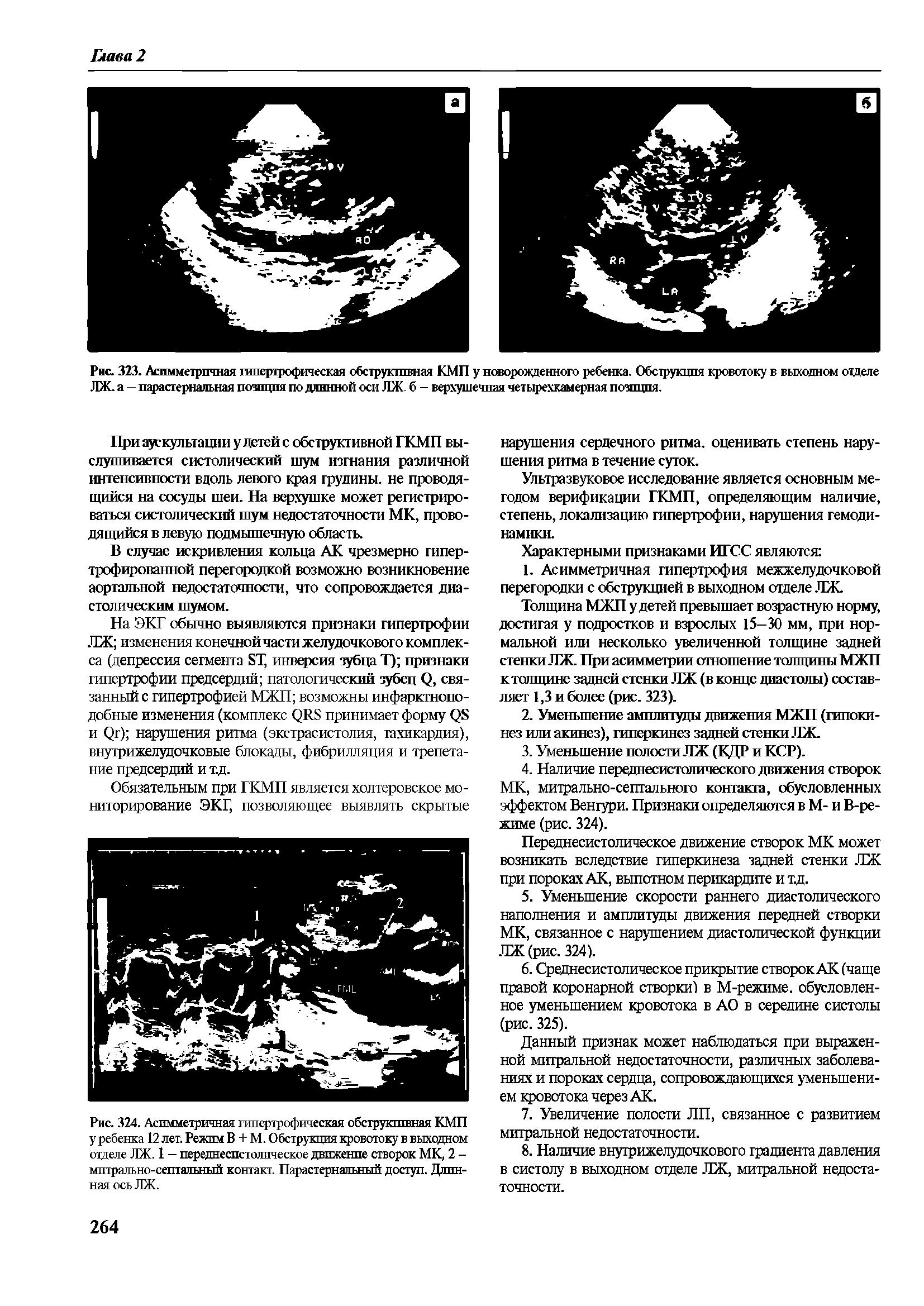 Рис. 323. Асимметричная гипертрофическая обструктивная КМП у новорожденного ребенка. Обструкция кровотоку в выходном отделе ЛЖ. а — парастернальная позиция по длинной оси ЛЖ. б - верхушечная четырехкамерная позиция.