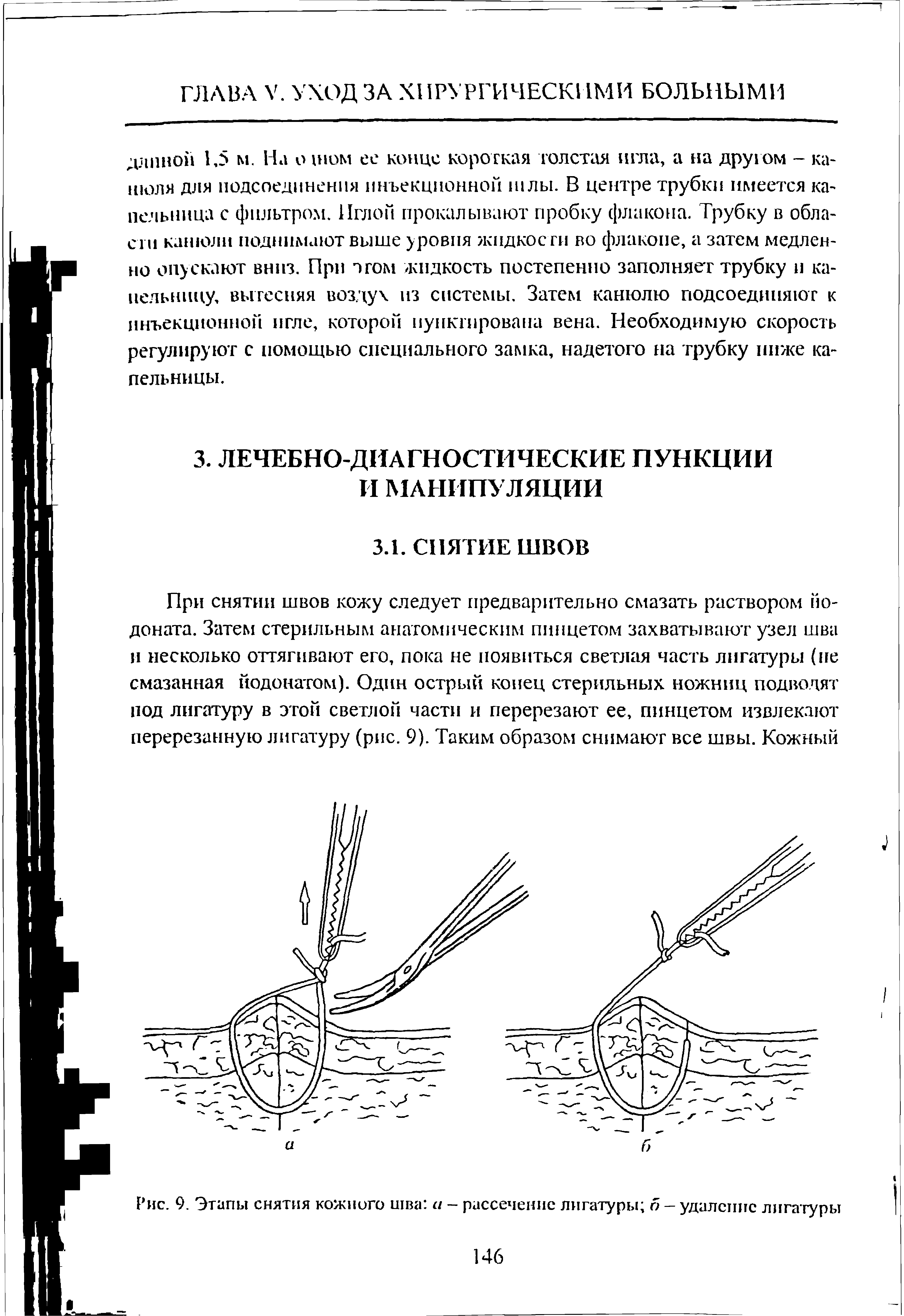 Рис. 9. Этапы снятия кожного шва а — рассечение лигатуры б — удаление лигатуры...