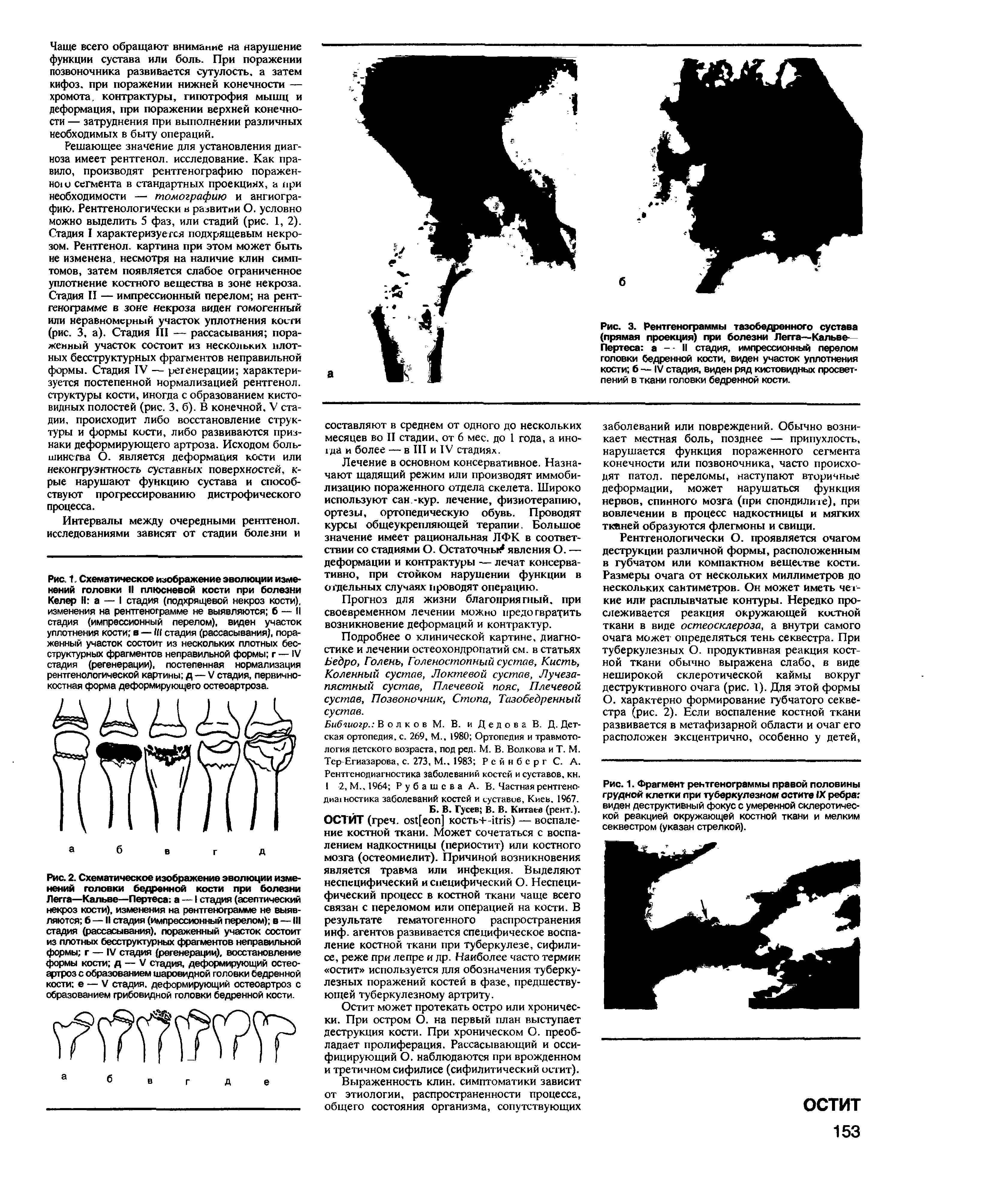 Рис. 3. Рентгенограммы тазобедренного сустава (прямая проекция) при болезни Легга—Кальве-Пертеса а - - II стадия, импрессионный перелом головки бедренной кости, виден участок уплотнения кости б — IV стадия, виден ряд кистовидных просветлений в ткани головки бедренной кости.