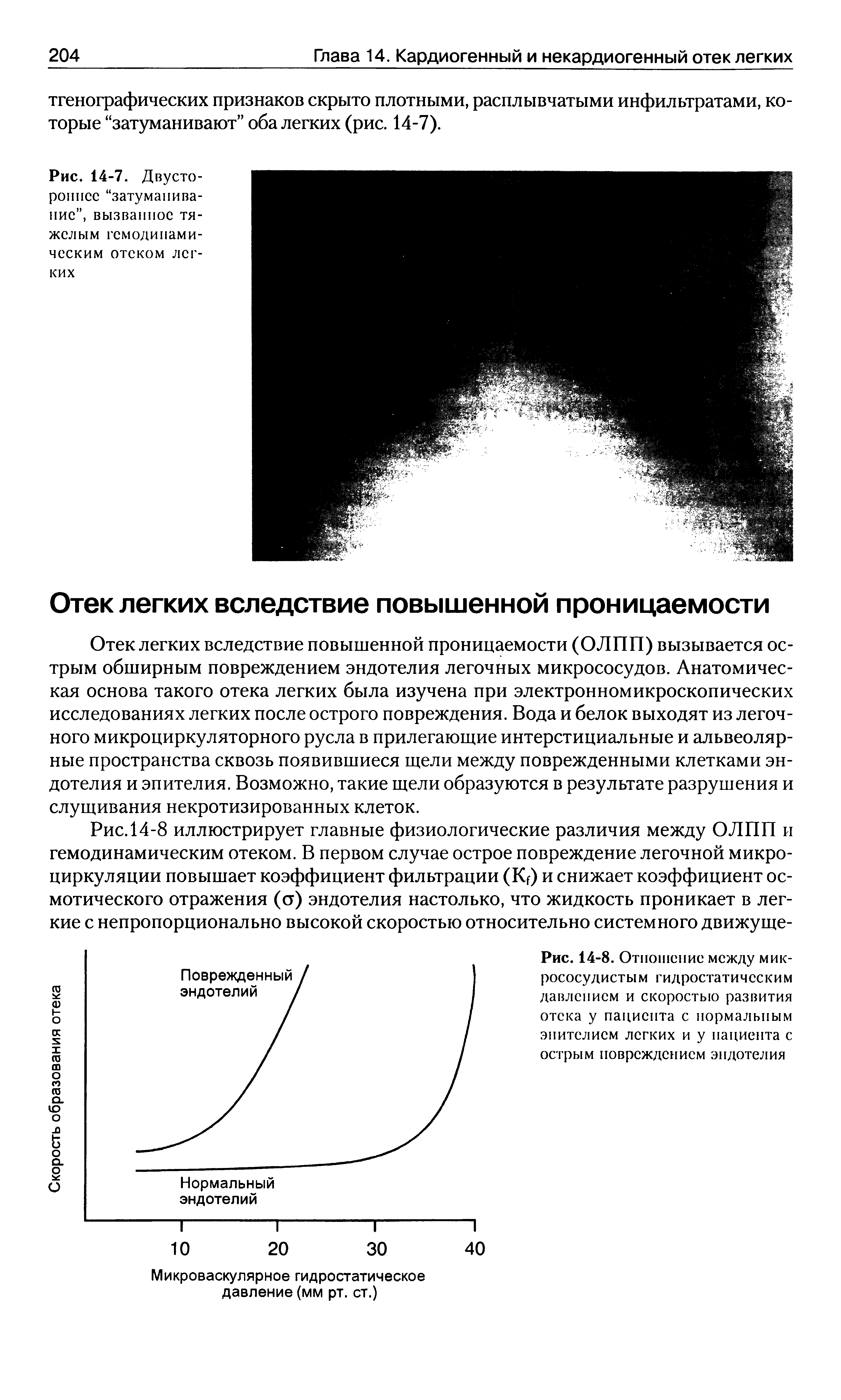 Рис. 14-7. Двустороннее затуманивание , вызванное тяжелым гемодинамическим отеком легких...