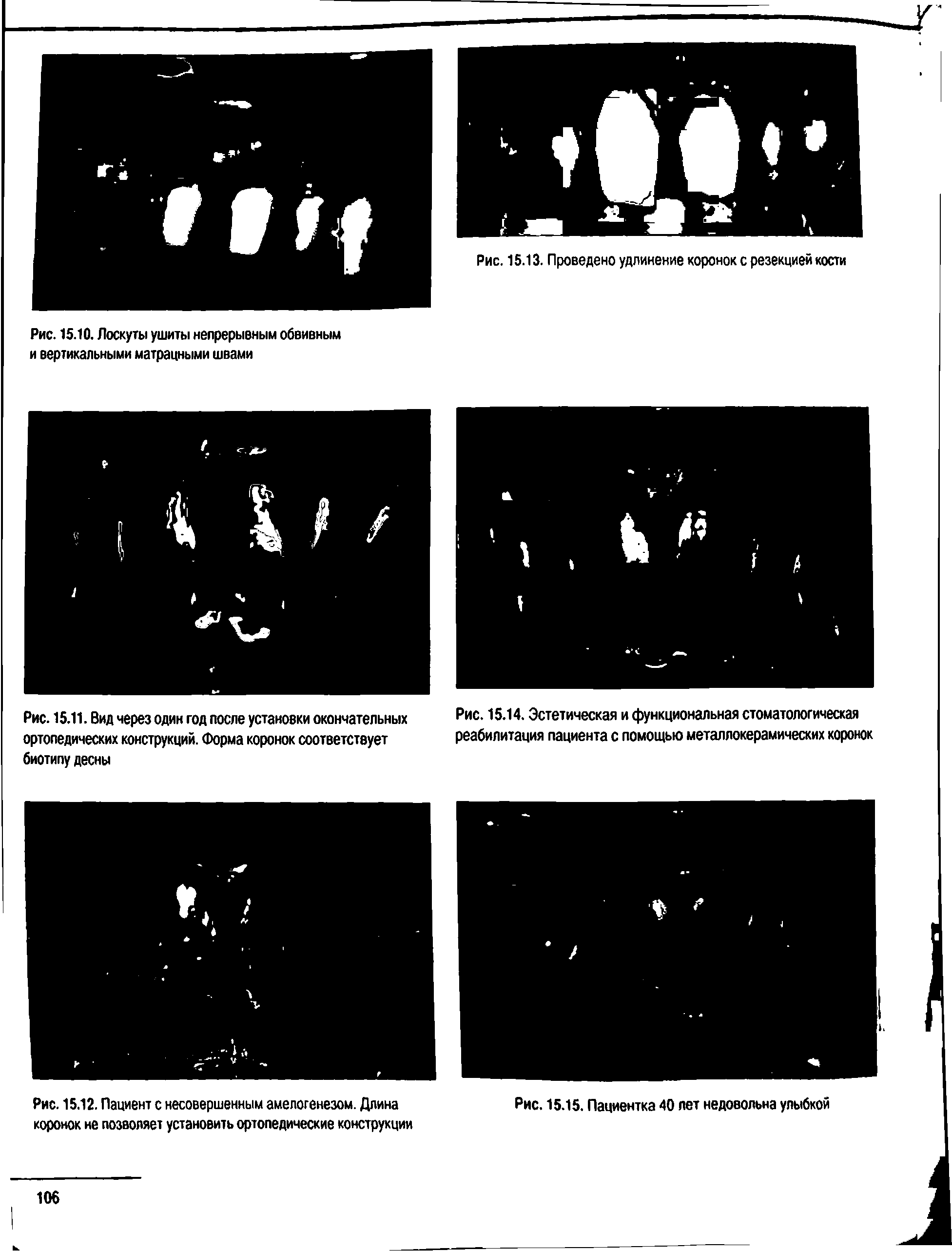 Рис. 15.14. Эстетическая и функциональная стоматологическая реабилитация пациента с помощью металлокерамических коронок...