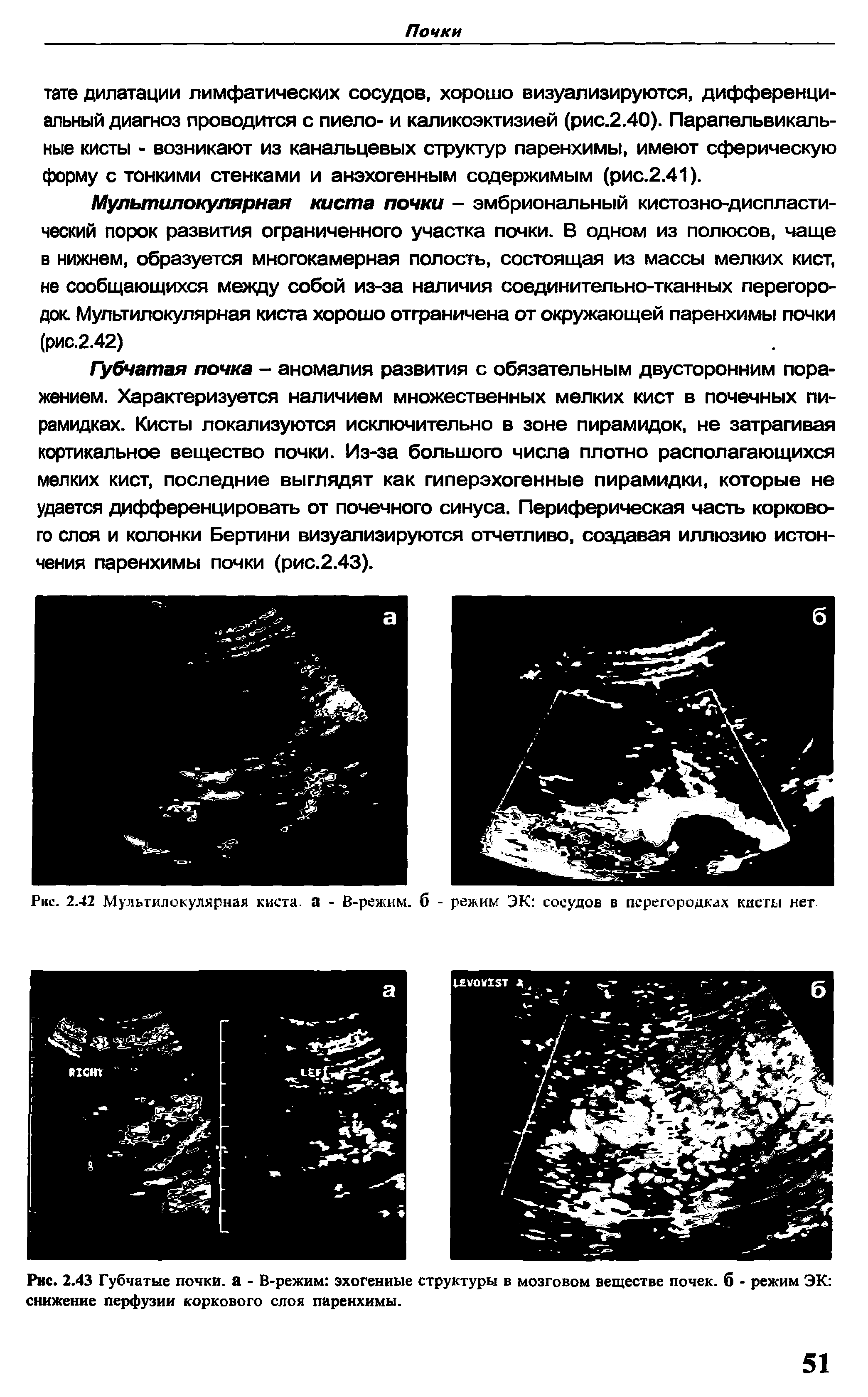 Рис. 2.42 Мультилокулярная киста, а - В-режим. б - режим ЭК сосудов в перегородках кисты нет...