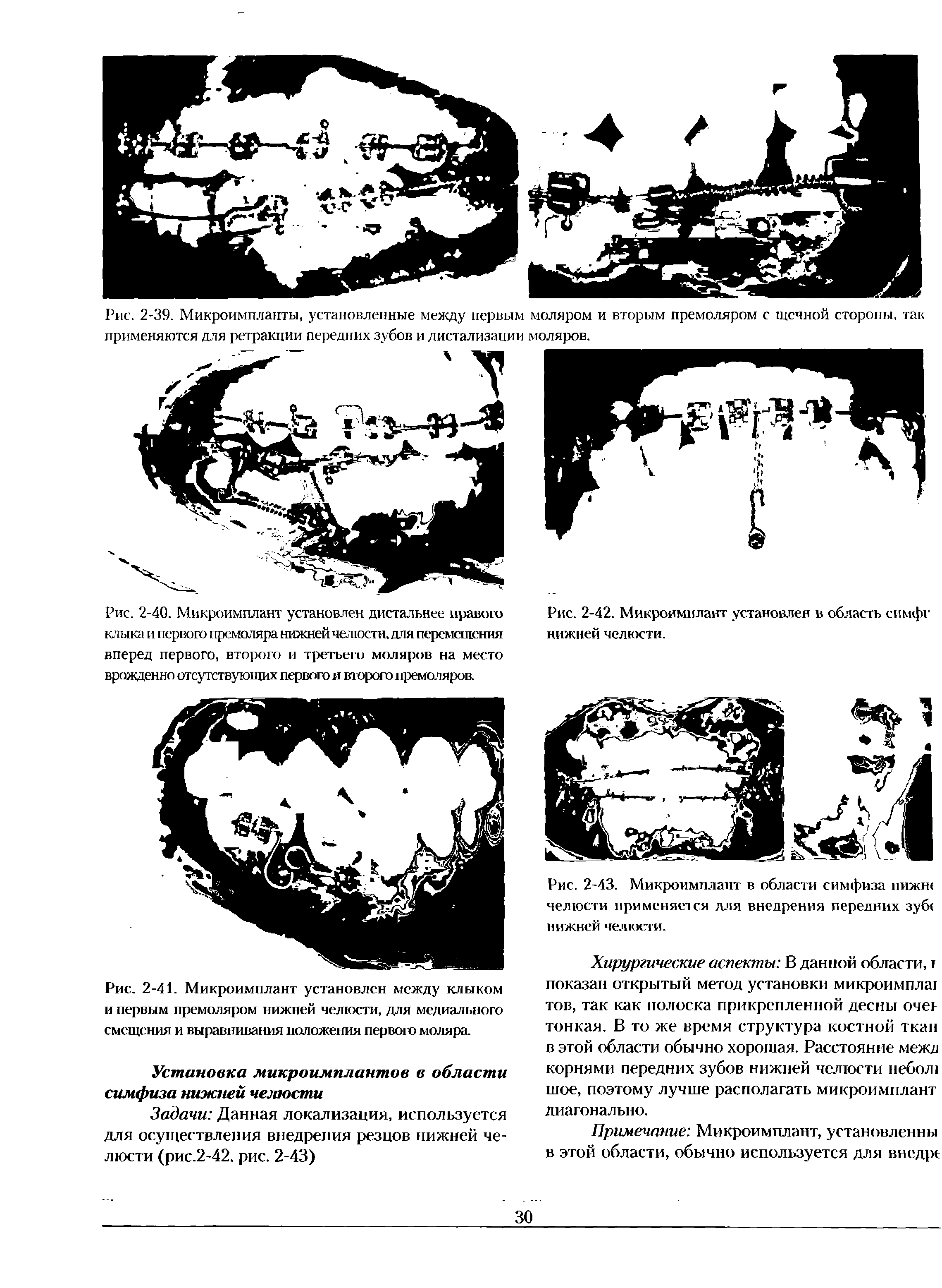 Рис. 2-41. Микроимплант установлен между клыком и первым премоляром нижней челюсти, для медиального смещения и выравнивания положения первого моляра.