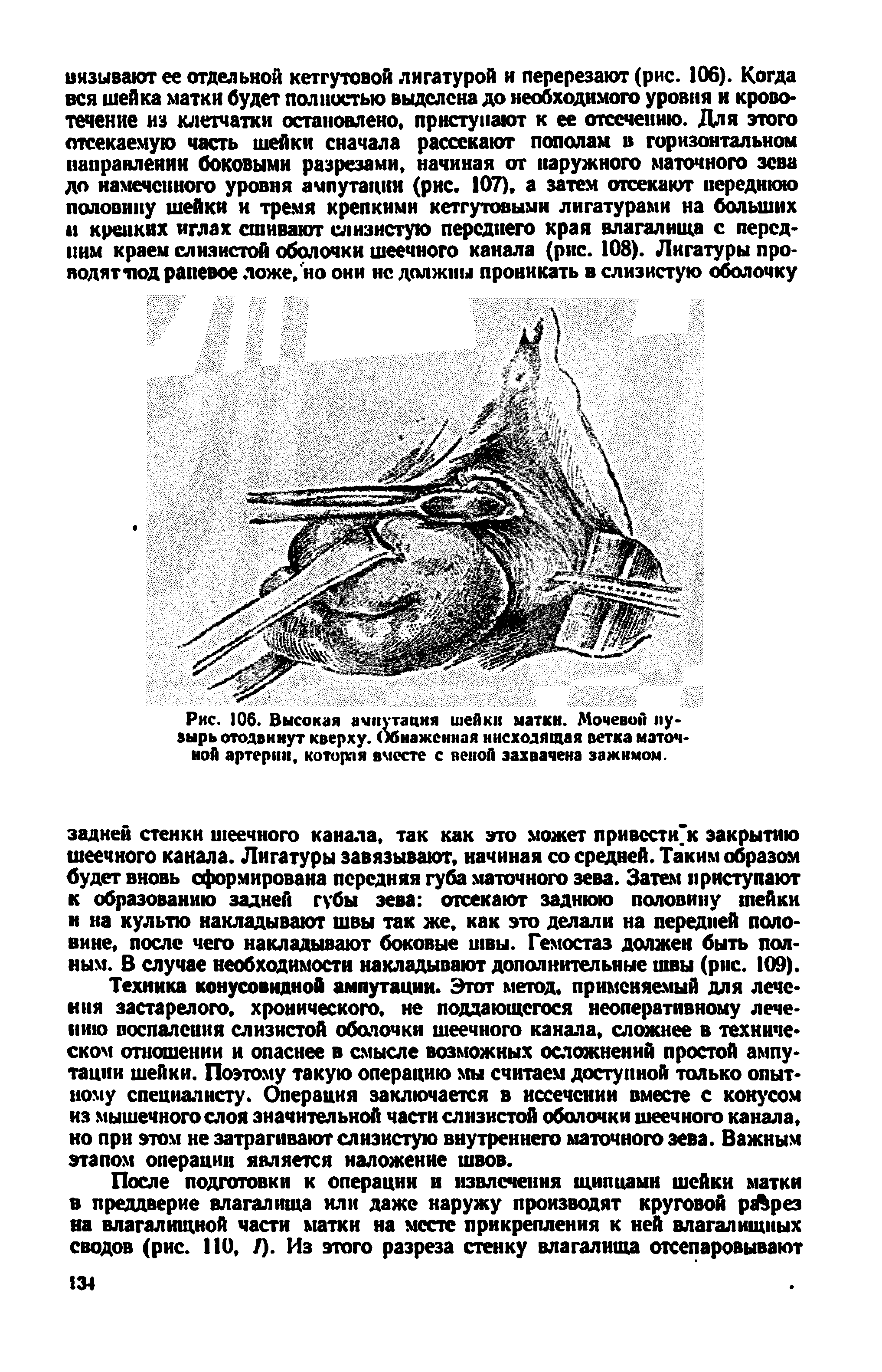 Рис. 106. Высокая ампутация шейки матки. Мочевой пузырь отодвинут кверху. Обнаженная нисходящая ветка маточной артерии, которая вместе с веной захвачена зажимом.