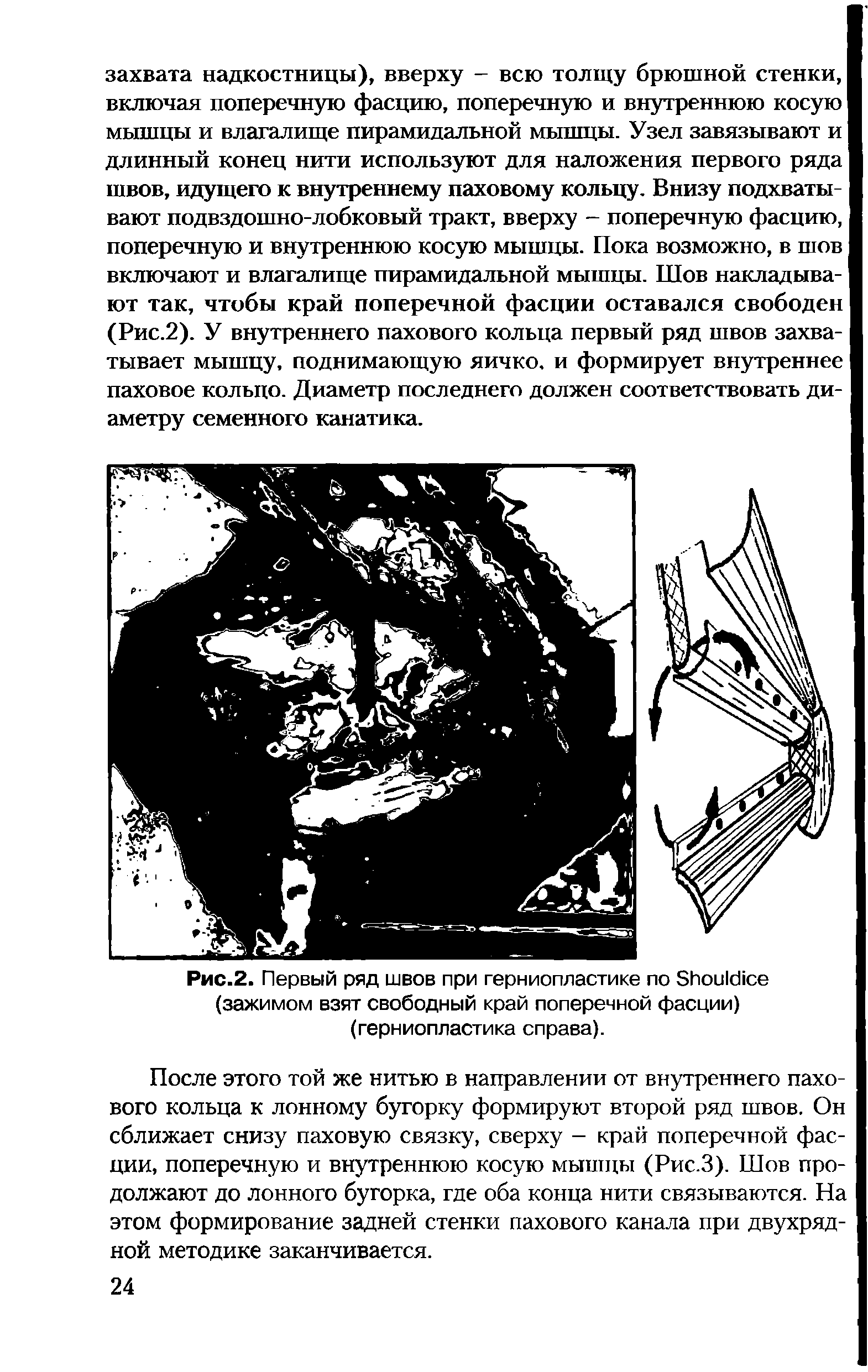 Рис.2. Первый ряд швов при герниопластике по S (зажимом взят свободный край поперечной фасции) (герниопластика справа).