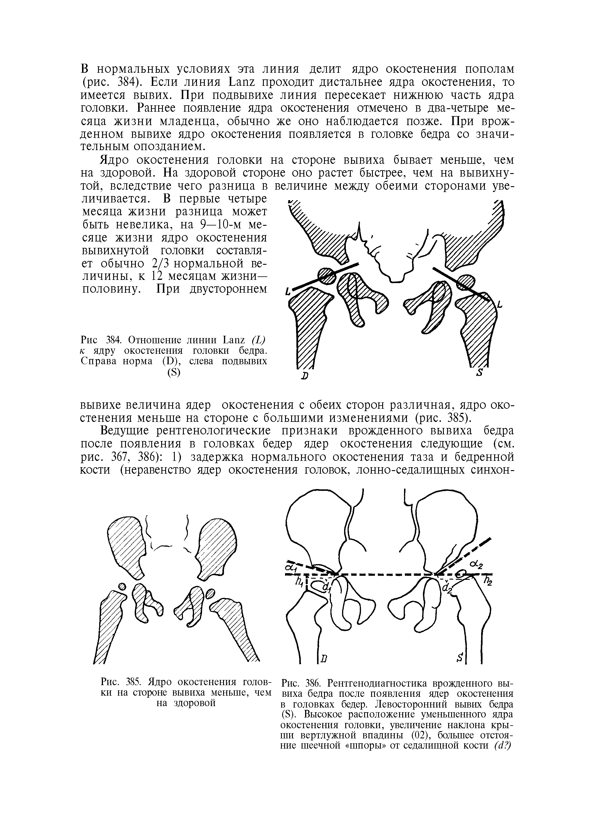 Рис. 385. Ядро окостенения голов- Рис. 386. Рентгенодиагностика врожденного быки на стороне вывиха меньше, чем виха бедра после появления ядер окостенения на здоровой в головках бедер. Левосторонний вывих бедра...