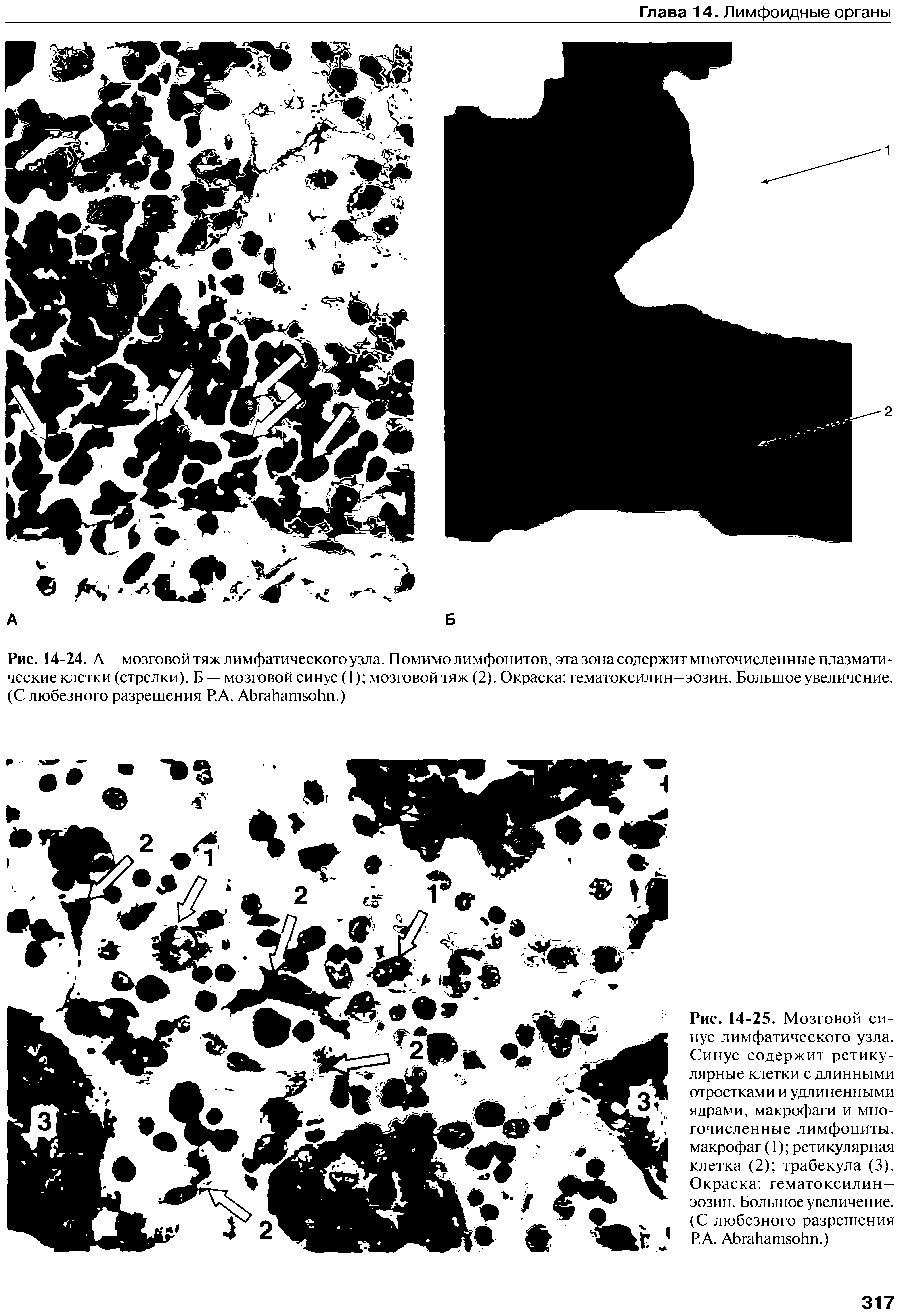 Рис. 14-25. Мозговой синус лимфатического узла. Синус содержит ретикулярные клетки с длинными отростками и удлиненными ядрами, макрофаги и многочисленные лимфоциты, макрофаг (1) ретикулярная клетка (2) трабекула (3). Окраска гематоксилин— эозин. Большое увеличение. (С любезного разрешения Р.А. АЬгаЬатзойп.)...