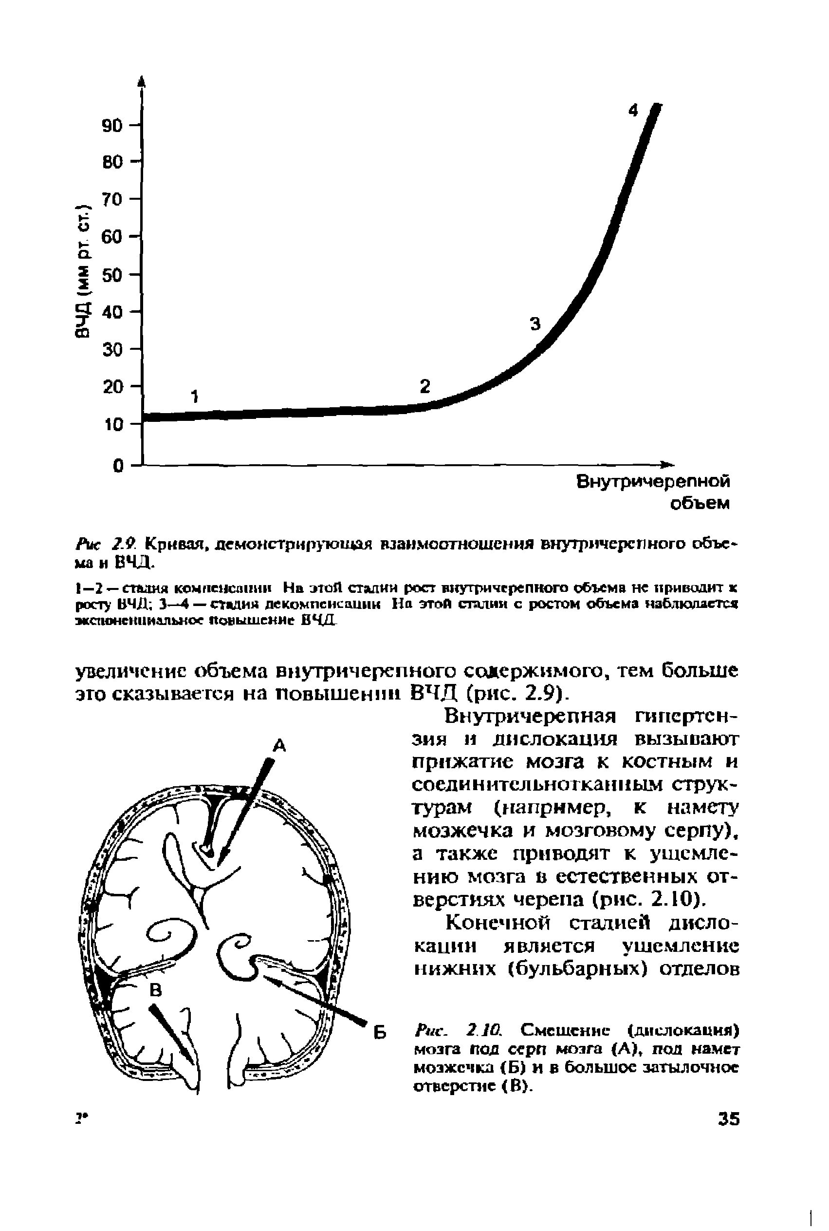 Рис. 2.10. Смешение (дислокация) мозга под серп мозга (А), под намет мозжечка (Б) и в большое затылочное отверстие (В).