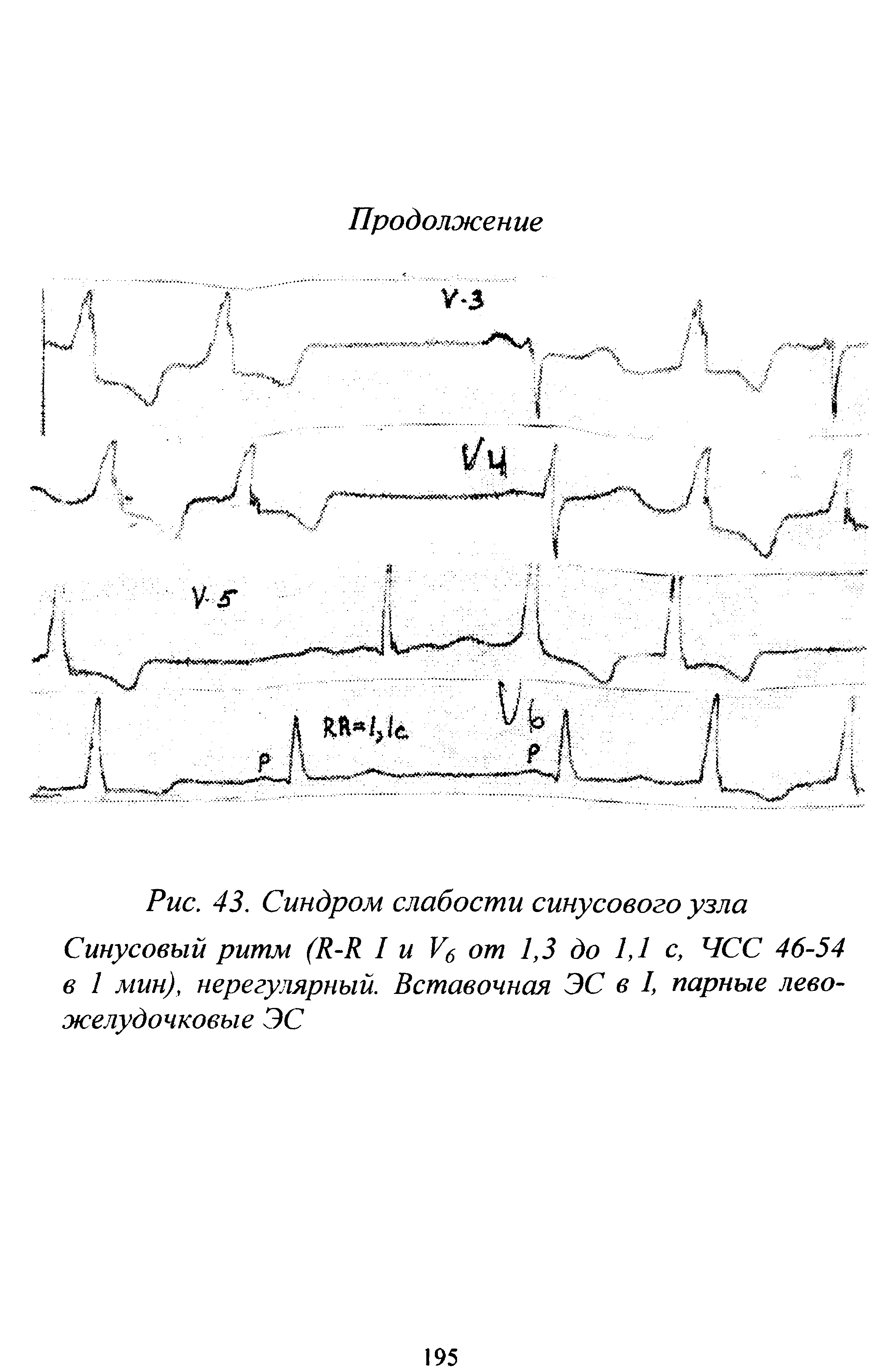Рис. 43. Синдром слабости синусового узла Синусовый ритм (Я-Я I и I) от 1,3 до 1,1 с, ЧСС 46-54 в 1 мин), нерегулярный. Вставочная ЭС в I, парные левожелудочковые ЭС...