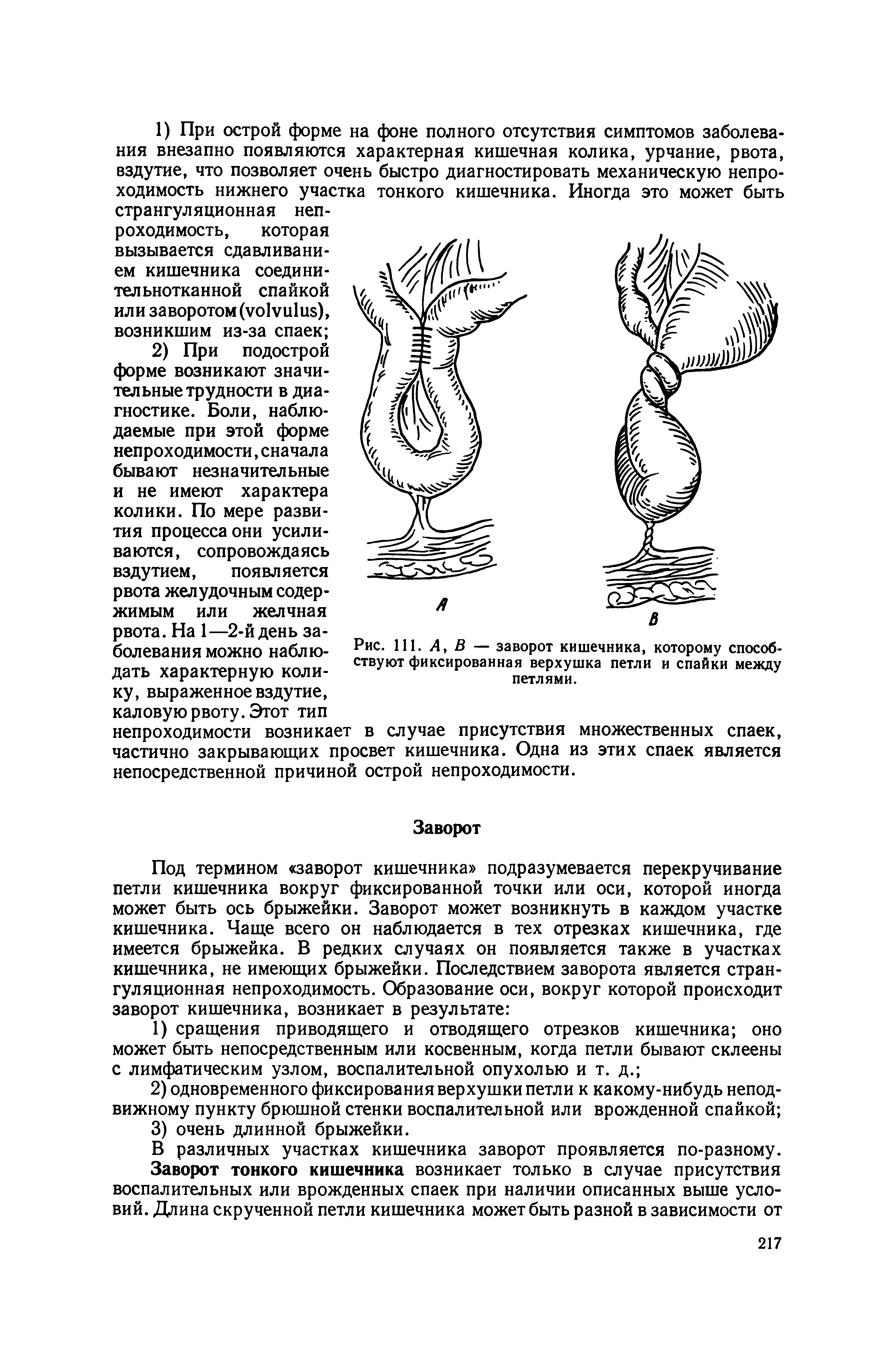 Рис. 111. Л, В — заворот кишечника, которому способствуют фиксированная верхушка петли и спайки между петлями.