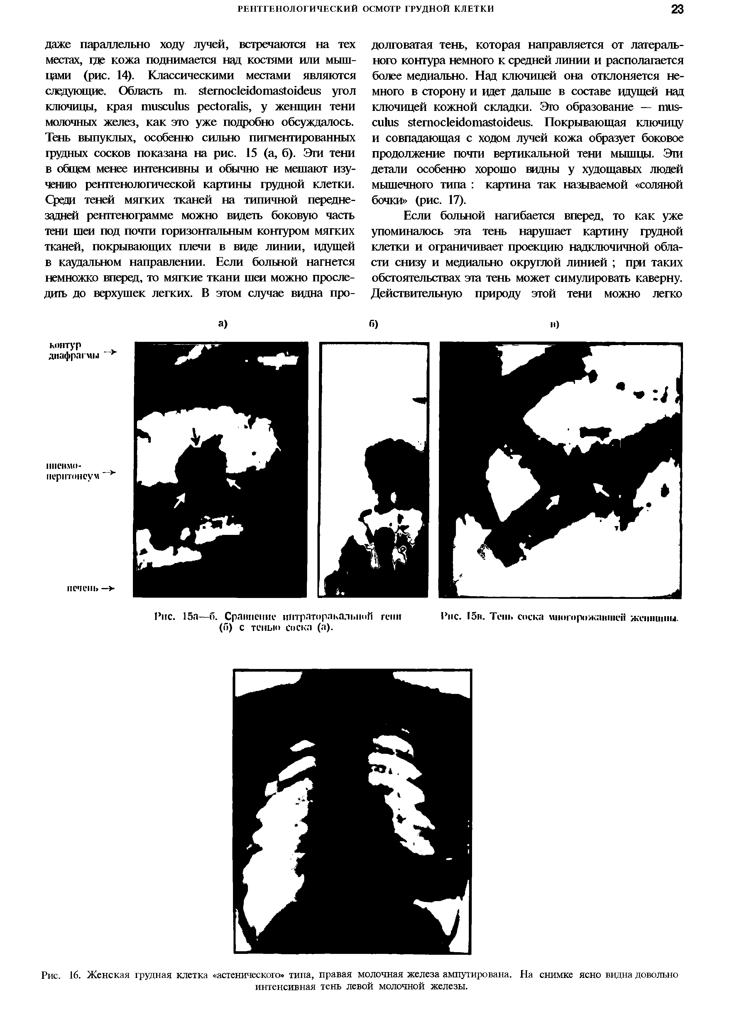 Рис. 16. Женская грудная клетка астенического типа, правая молочная железа ампутирована. На снимке ясно видна довольно интенсивная тень левой молочной железы.