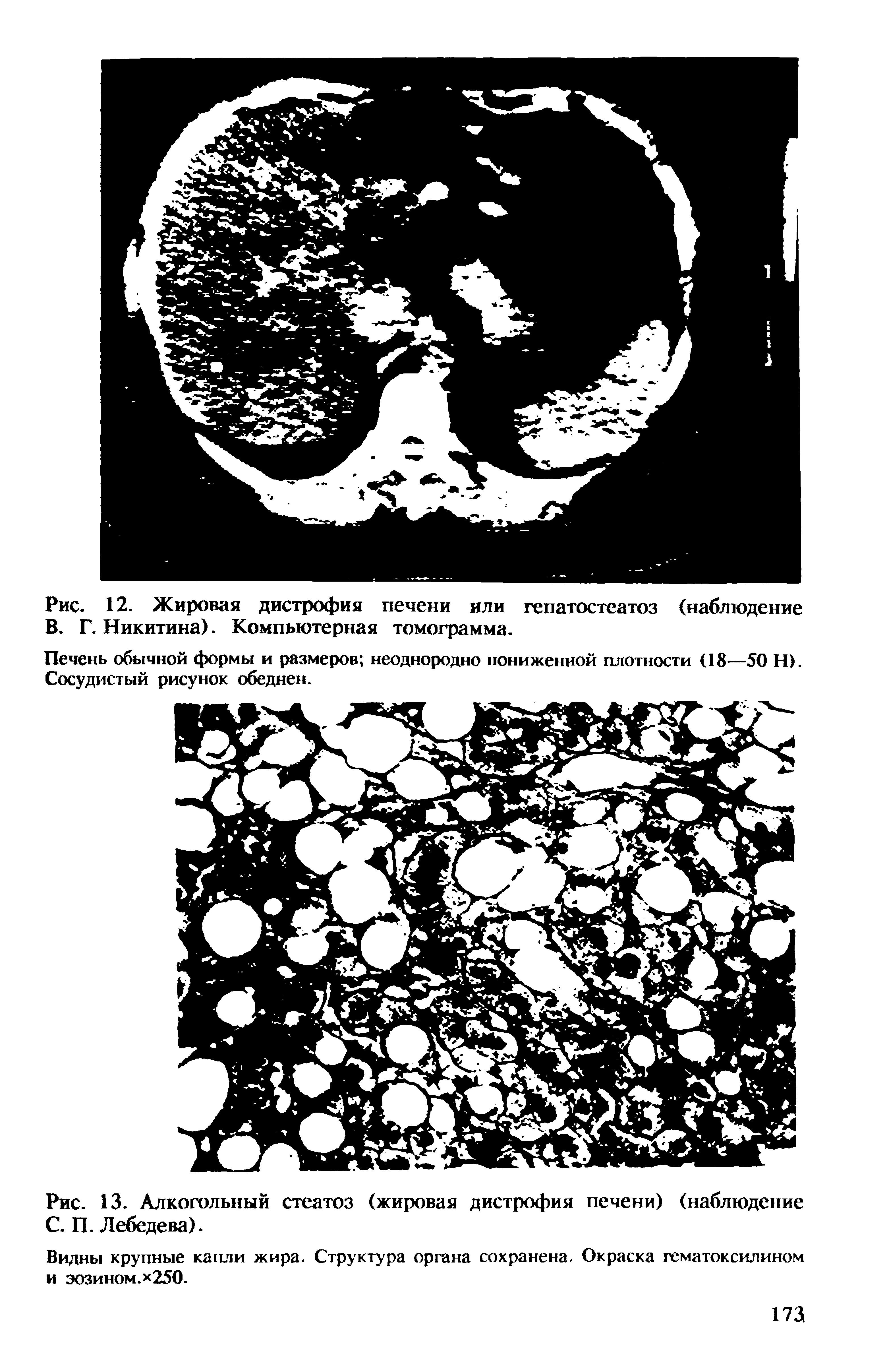 Рис. 13. Алкогольный стеатоз (жировая дистрофия печени) (наблюдение С. П. Лебедева).